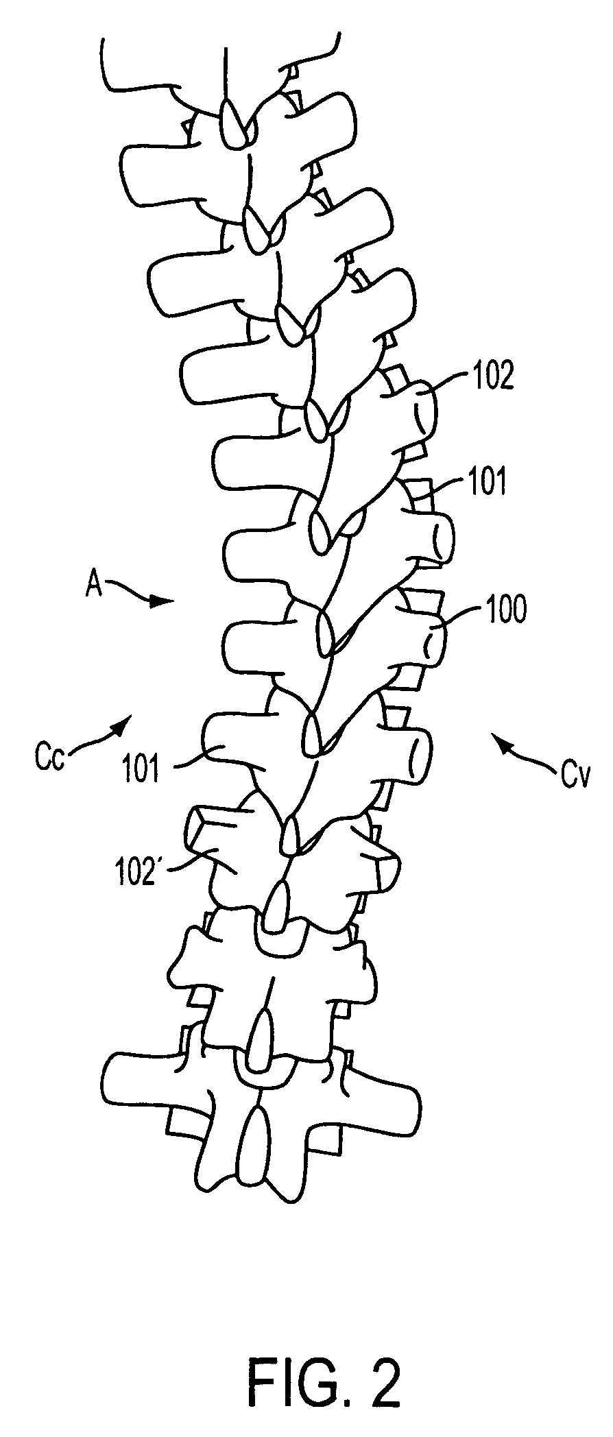 Device for dynamic spinal fixation for correction of spinal deformities