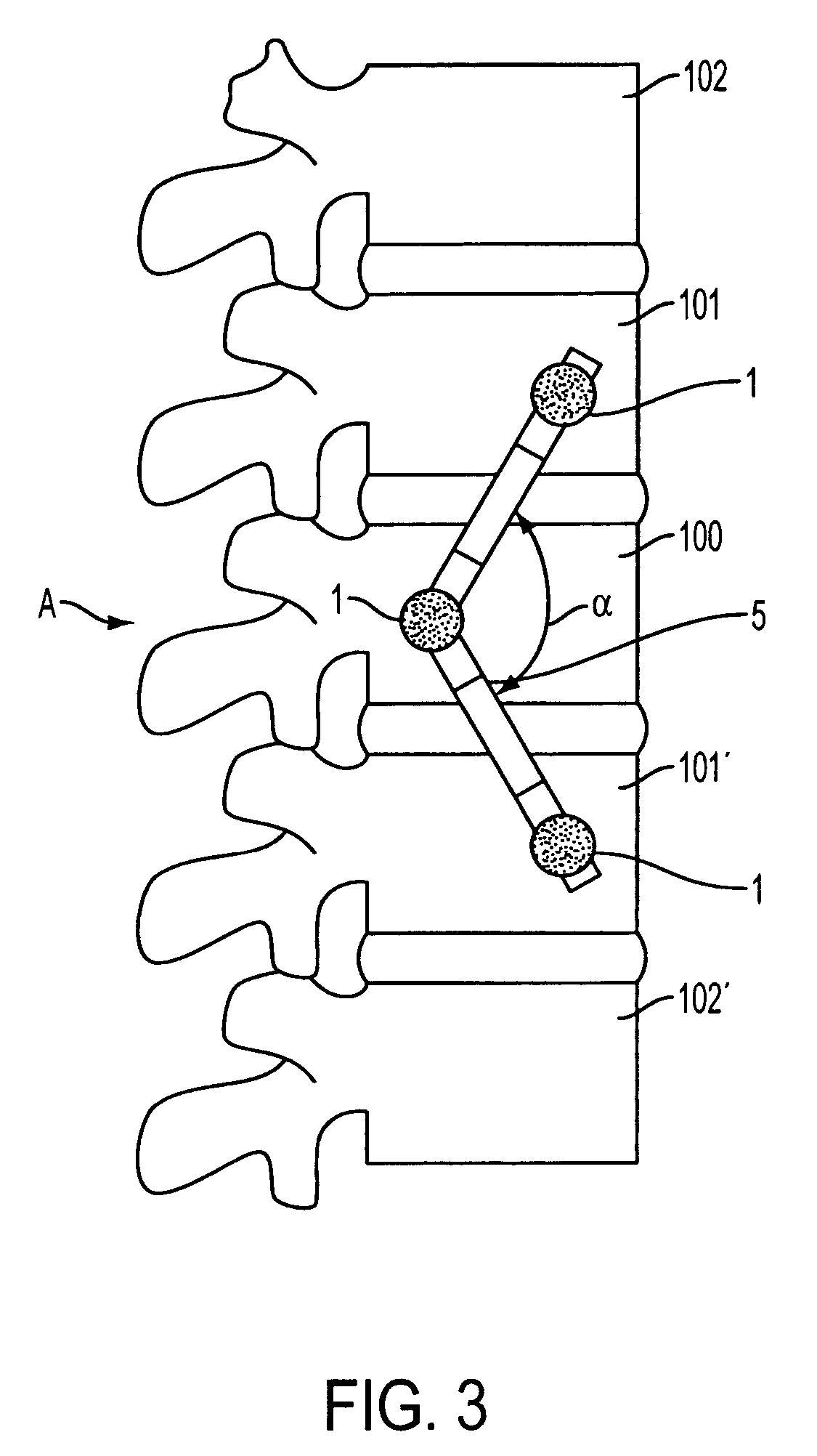 Device for dynamic spinal fixation for correction of spinal deformities
