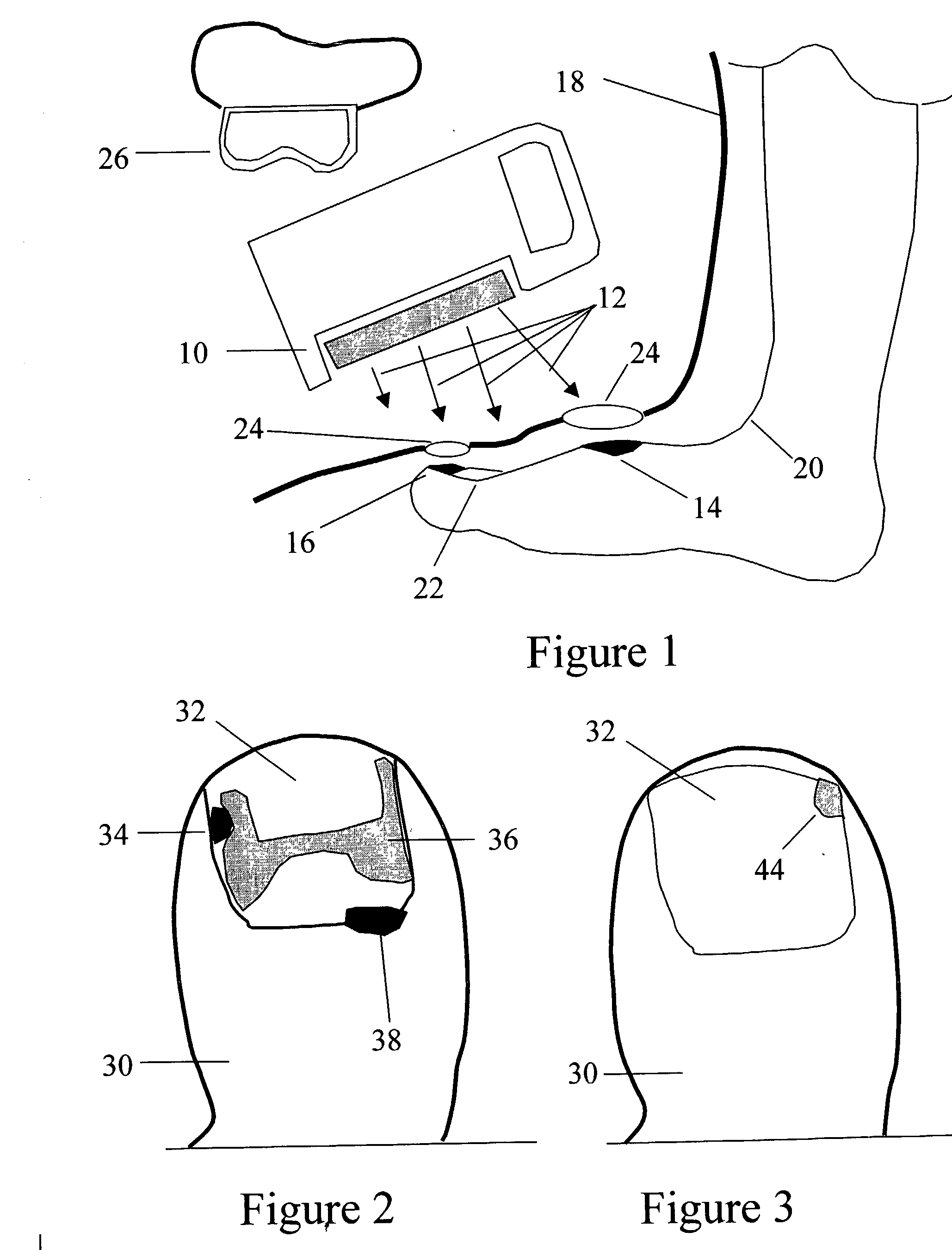 Method for the prevention and treatment of skin and nail infections