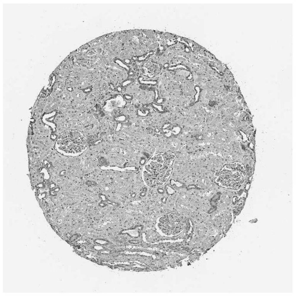 Application of ddx20 in the preparation of postoperative prognosis assessment kit for clear cell renal cell carcinoma