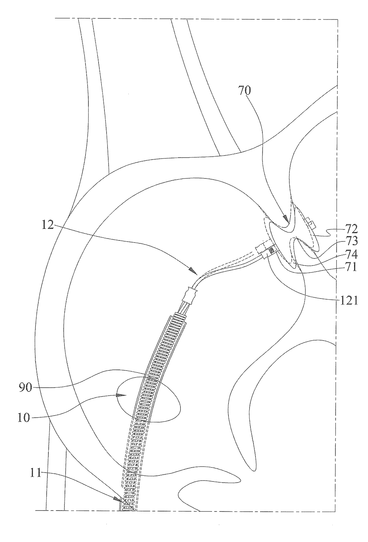 Delivery Apparatus for a Medical Device