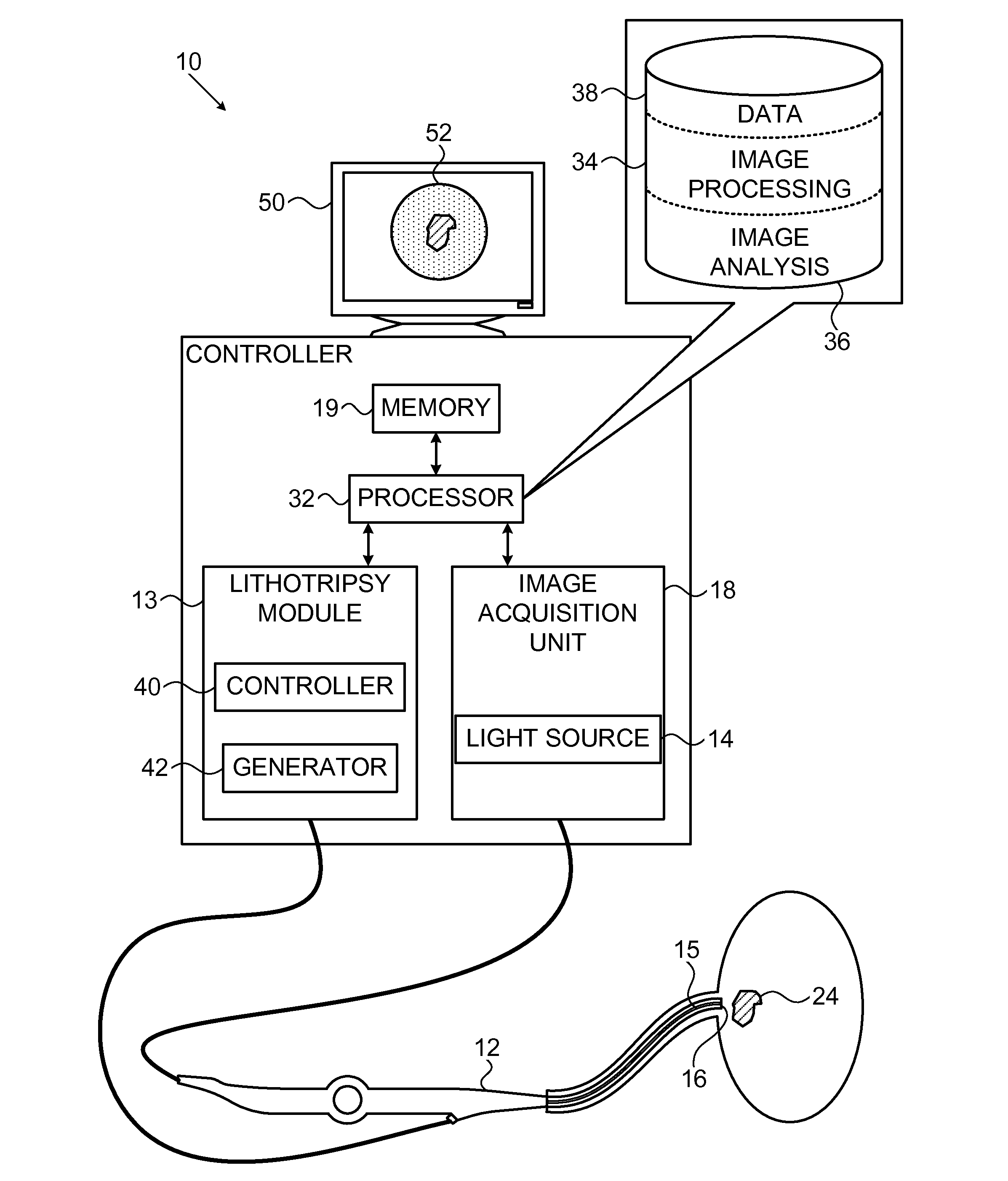 Computer aided image-based enhanced intracorporeal lithotripsy