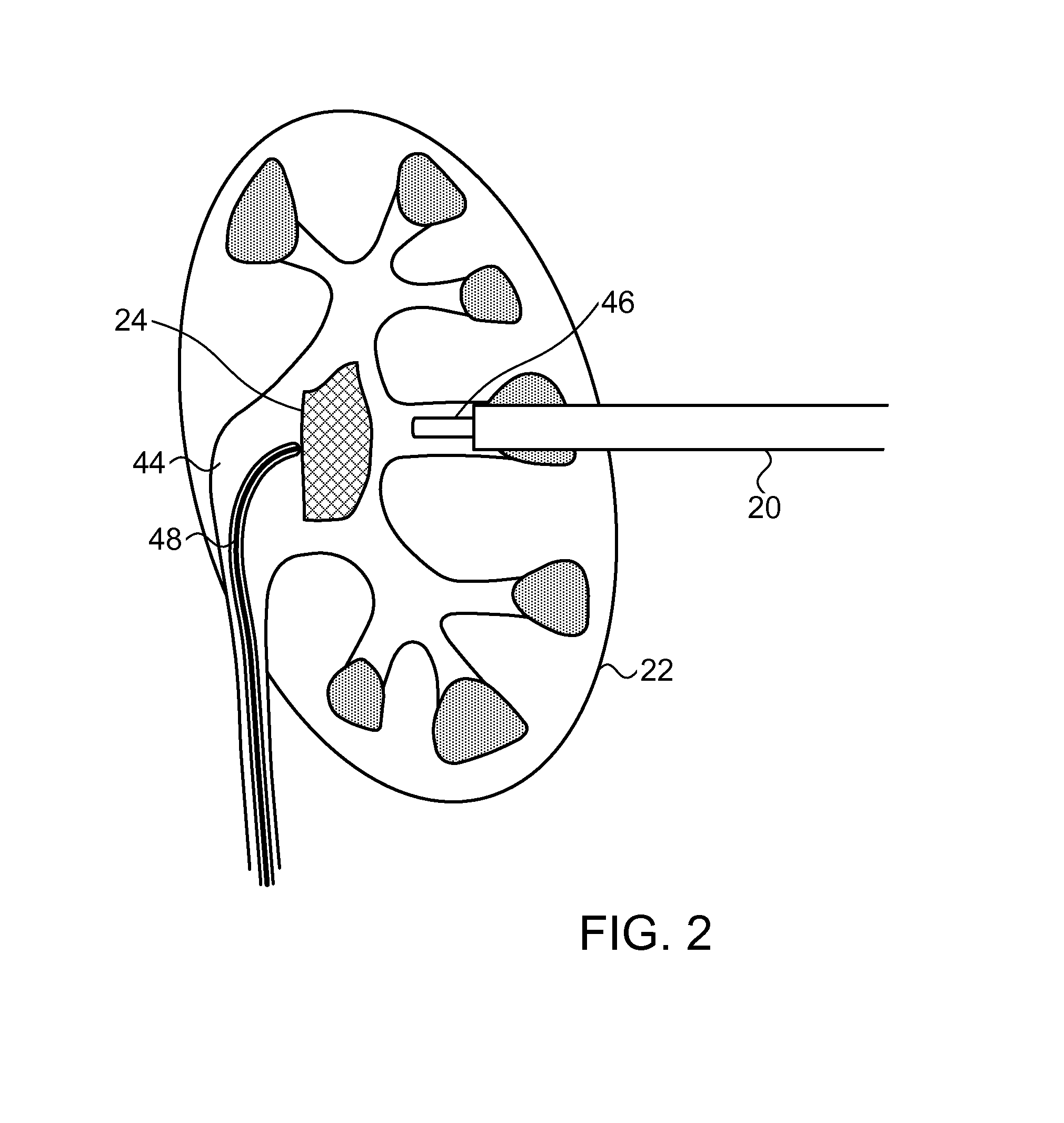 Computer aided image-based enhanced intracorporeal lithotripsy