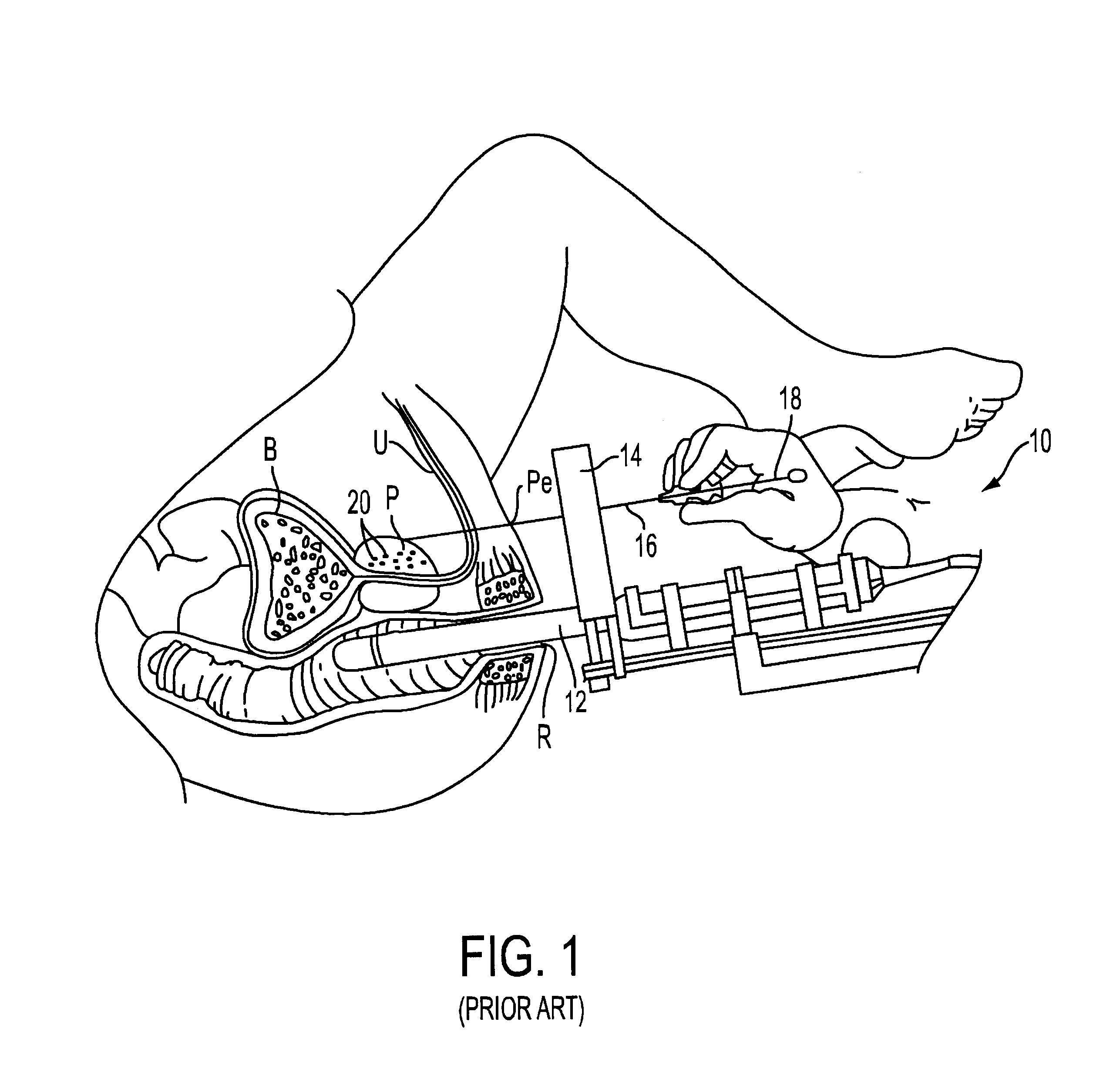 Methods and apparatus for loading radioactive seeds into brachytherapy needles