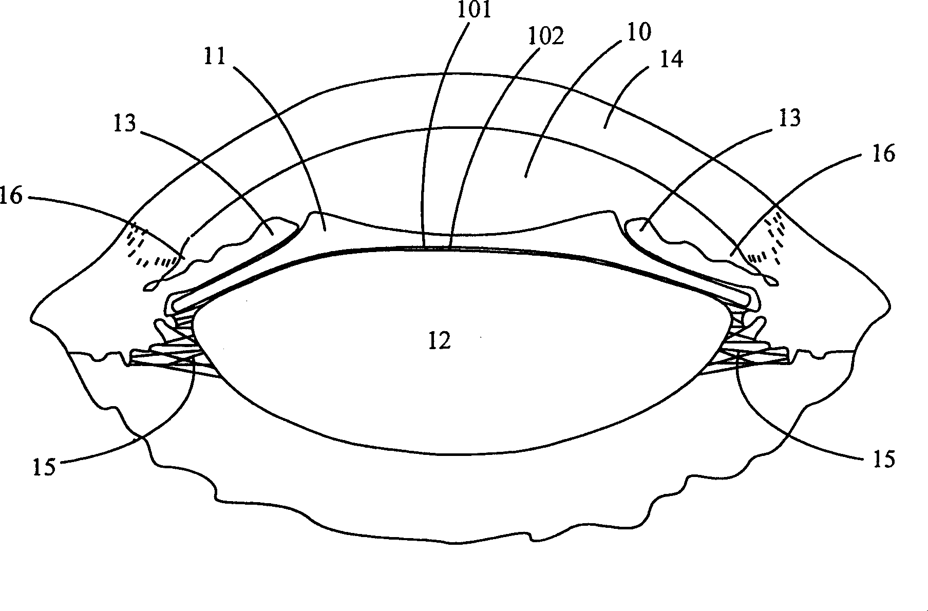 Intraocular phototropism lens and implantation method thereof