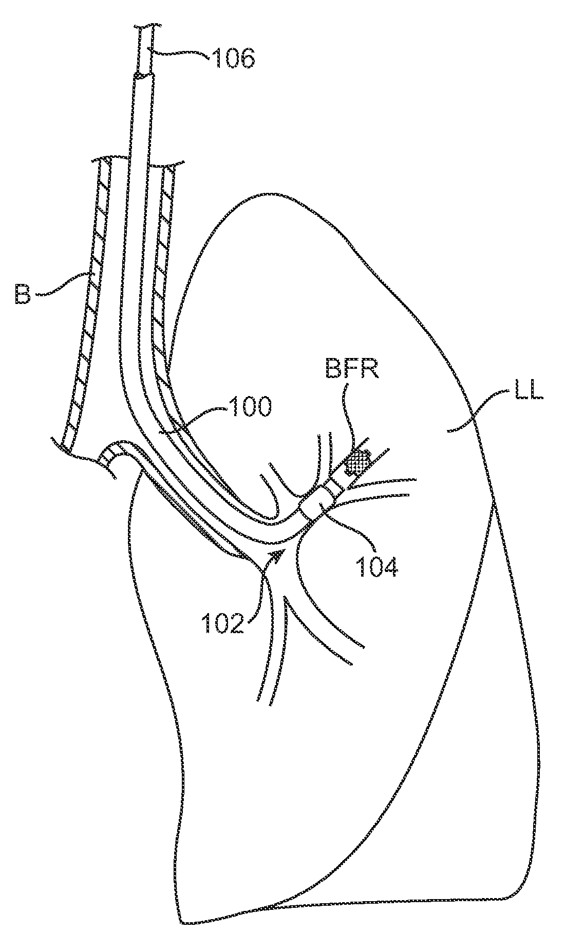Methods and devices to induce controlled atelectasis and hypoxic pulmonary vasoconstriction
