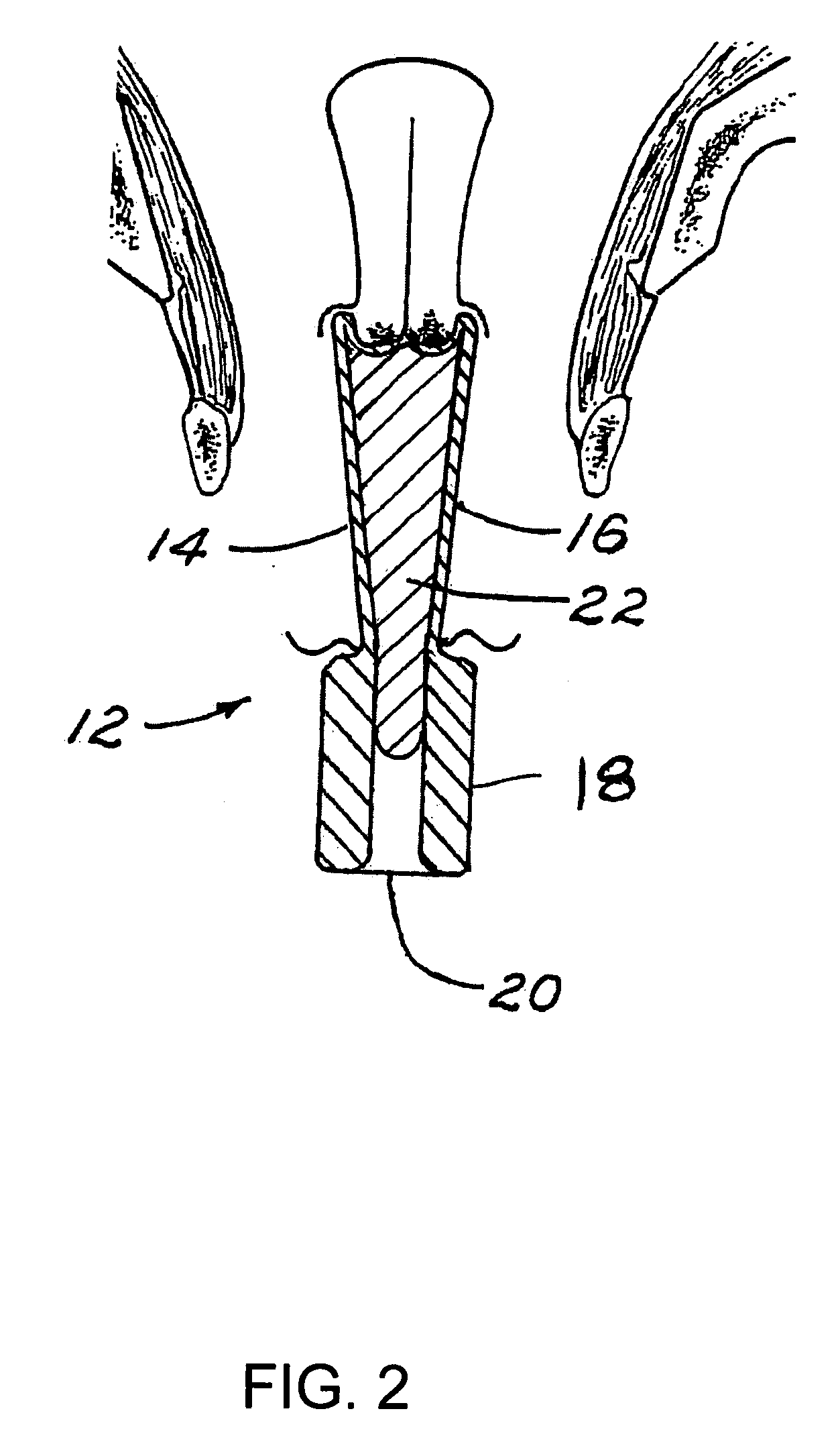 Customized gynecological brachytherapy applicator and method