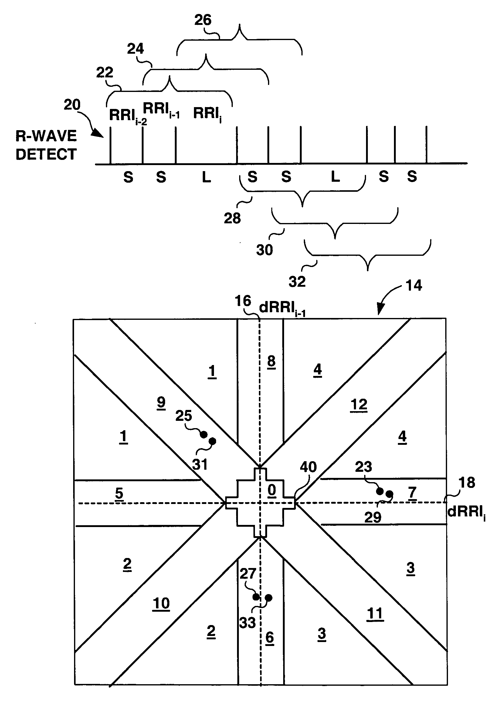Method and apparatus for detection of tachyarrhythmia using cycle lengths