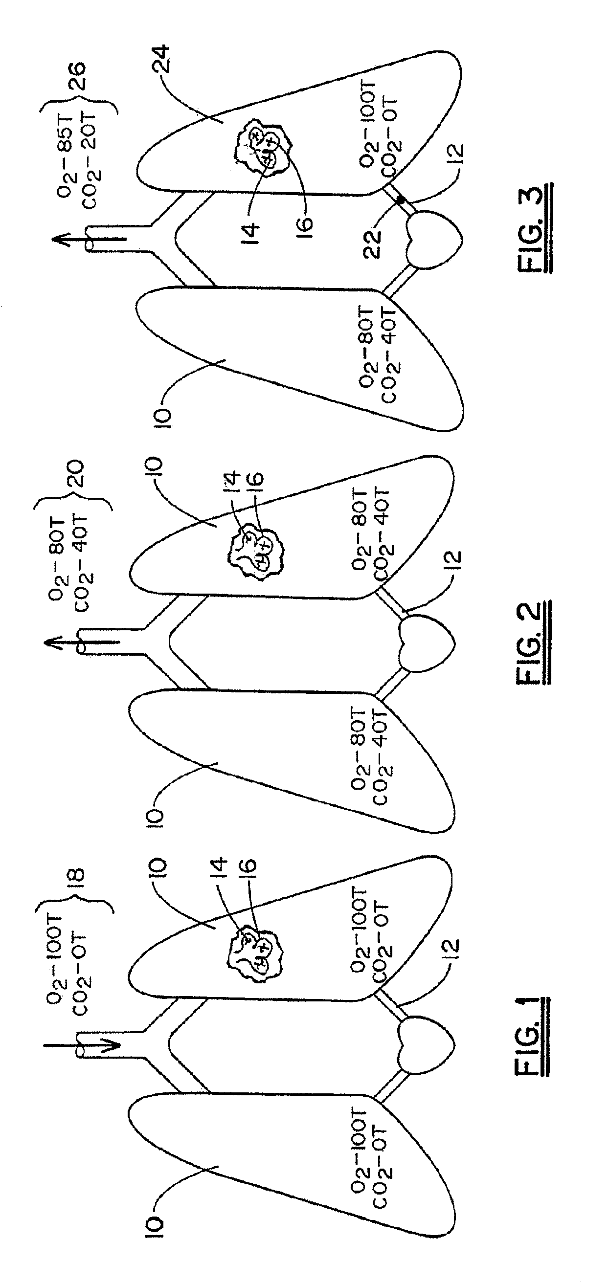 Method and system for diagnosing post-surgical pulmonary vascular occlusions