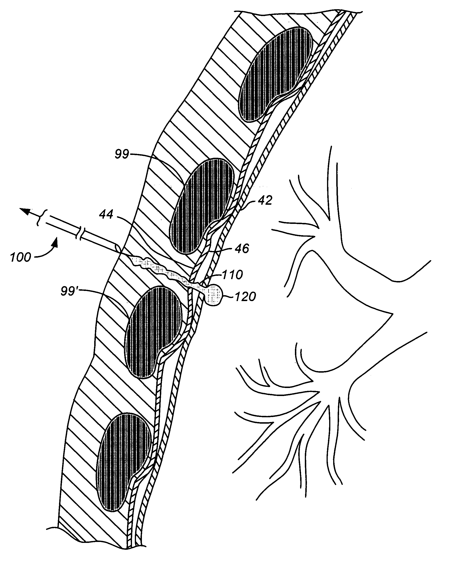 Lung device with sealing features