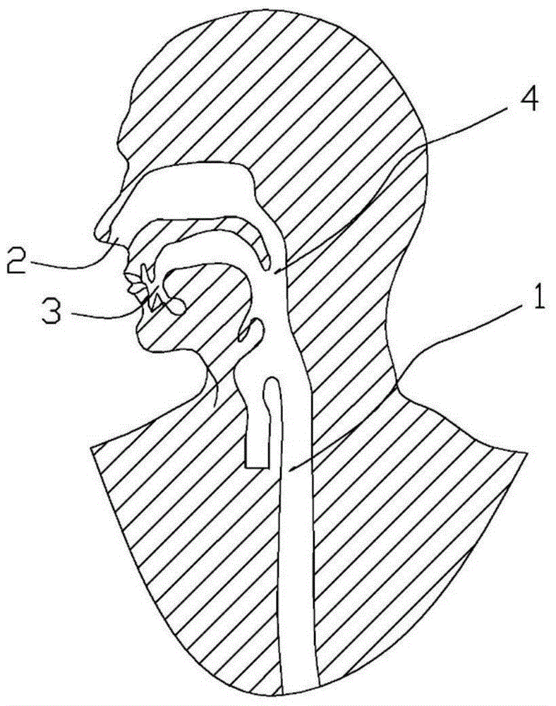 An anti-displacement esophageal stent kit