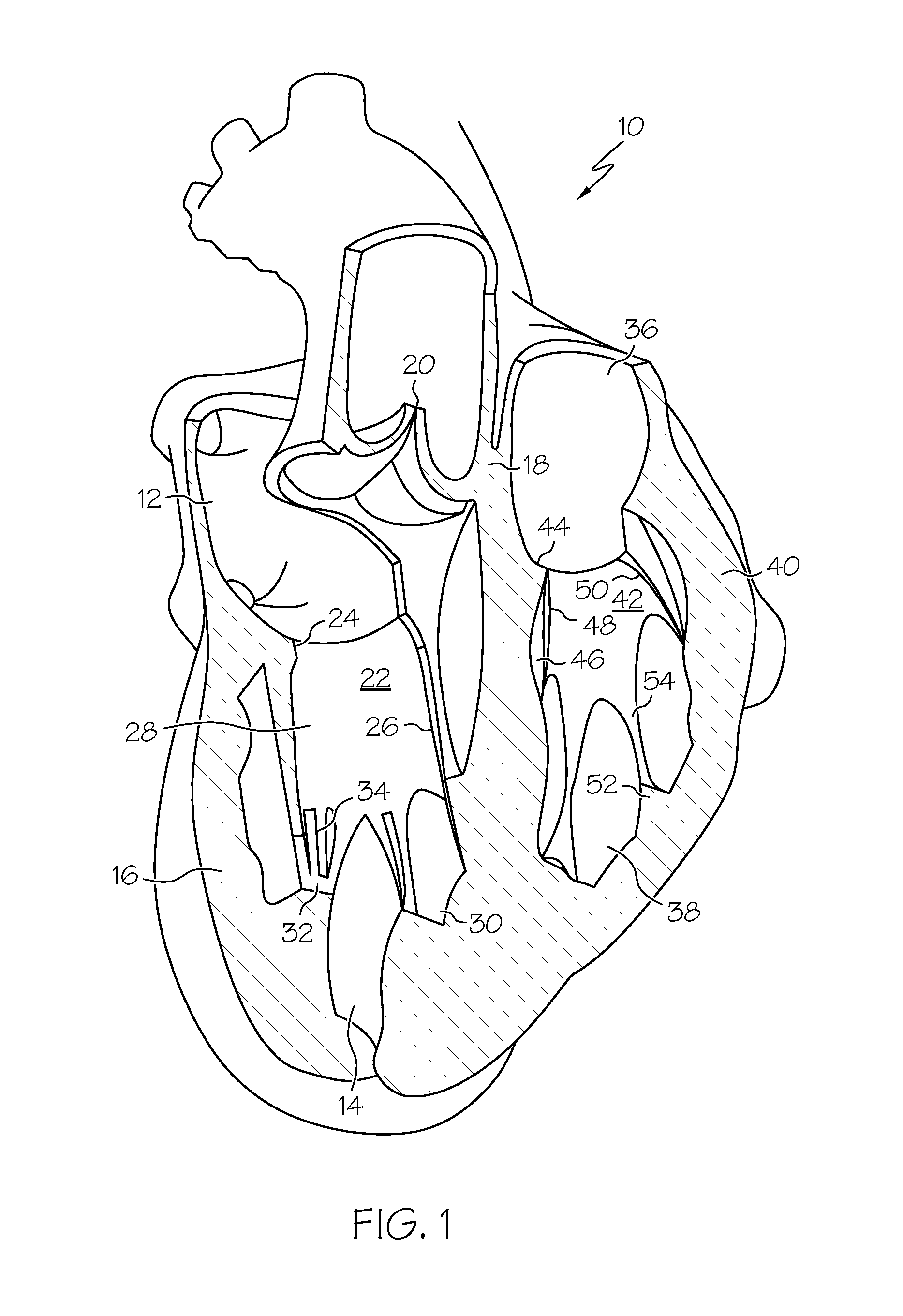 Percutaneous Mitral Annulus Mini-Plication
