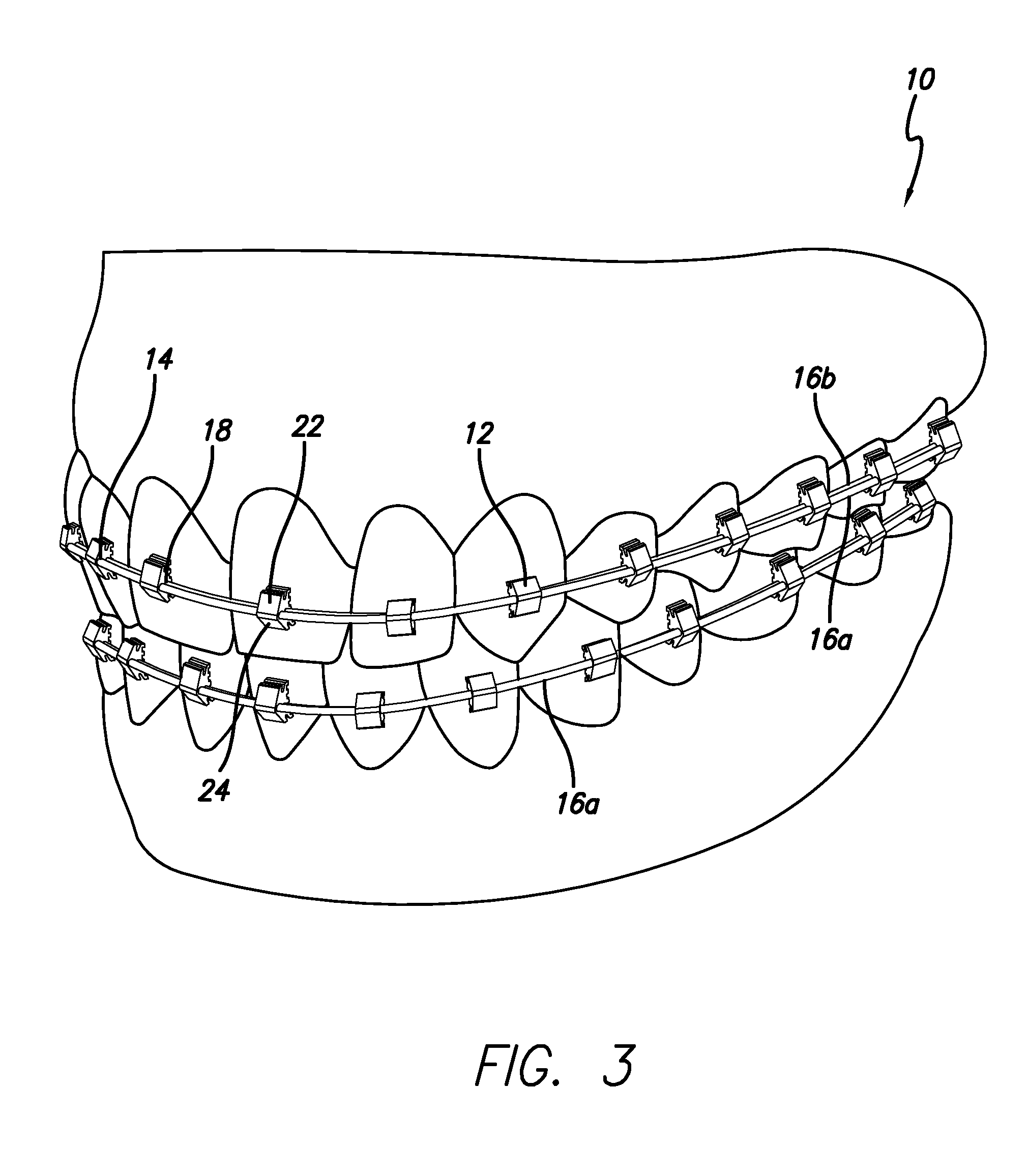 Orthodontic bracket system and method