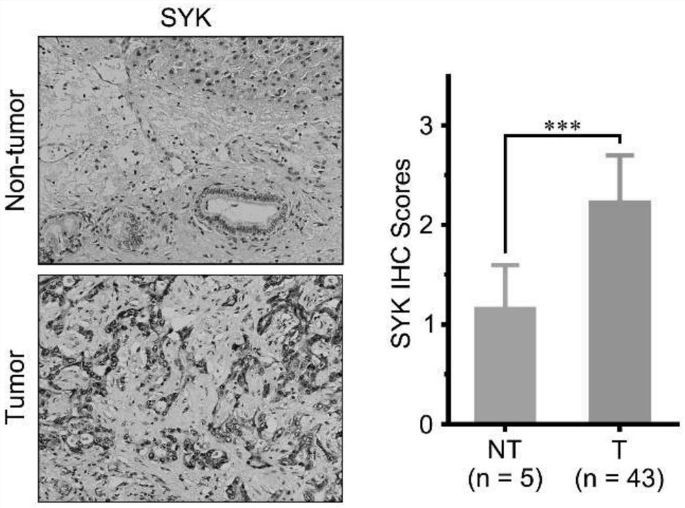 Spleen tyrosine kinase as a therapeutic target for intrahepatic cholangiocarcinoma