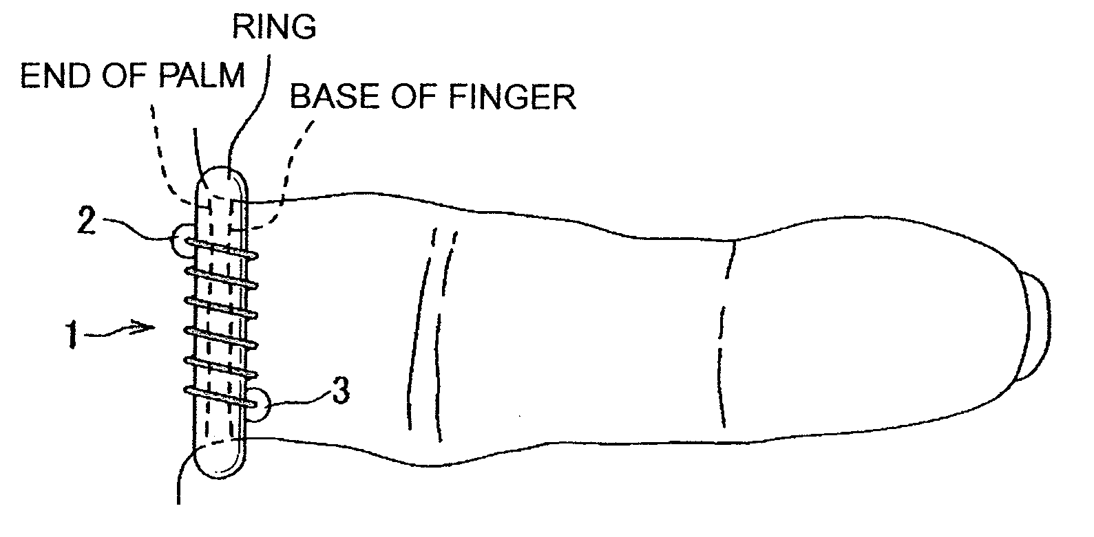 Fitting device for ring