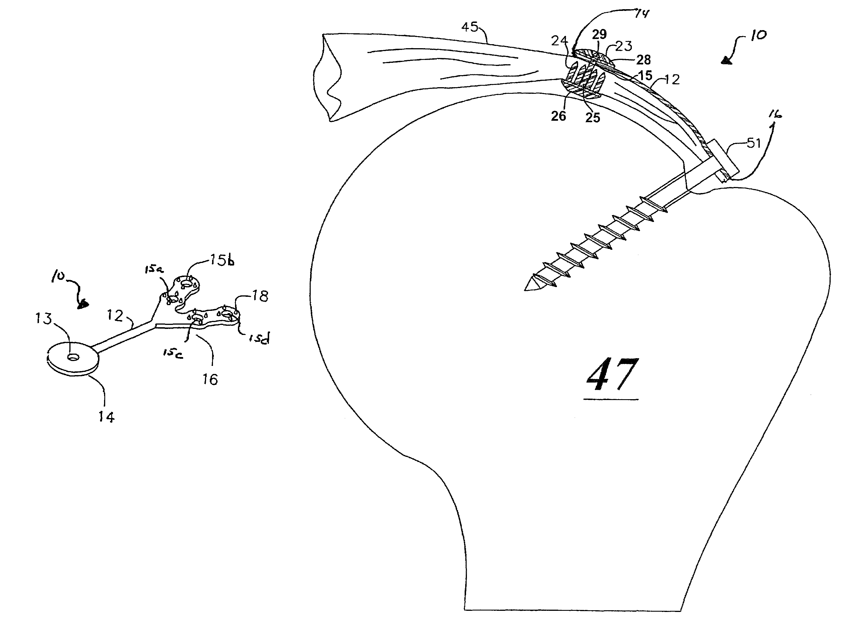 Apparatus and method for use in repairs of injured soft tissue