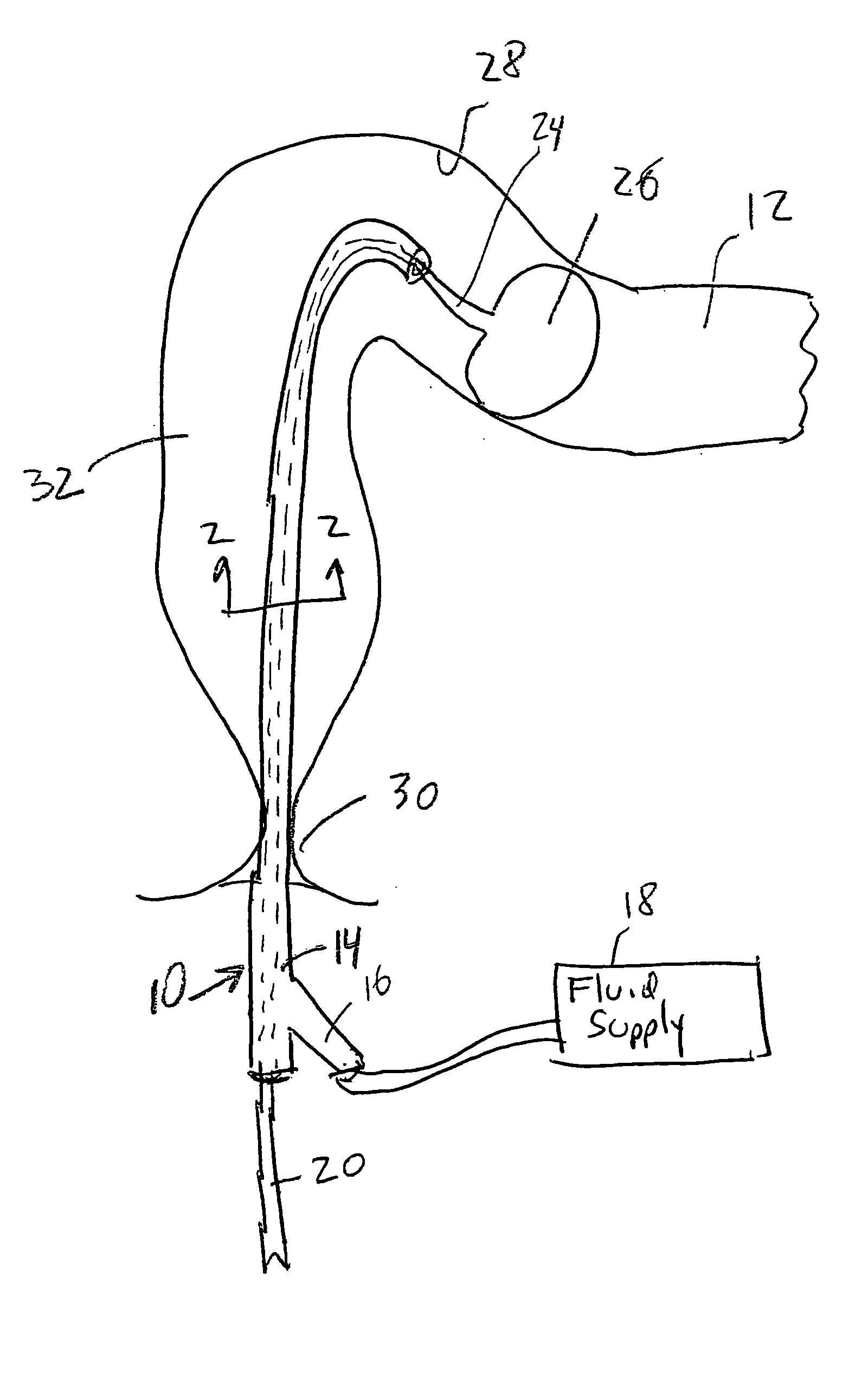 Guidewire for use in colonic irrigation