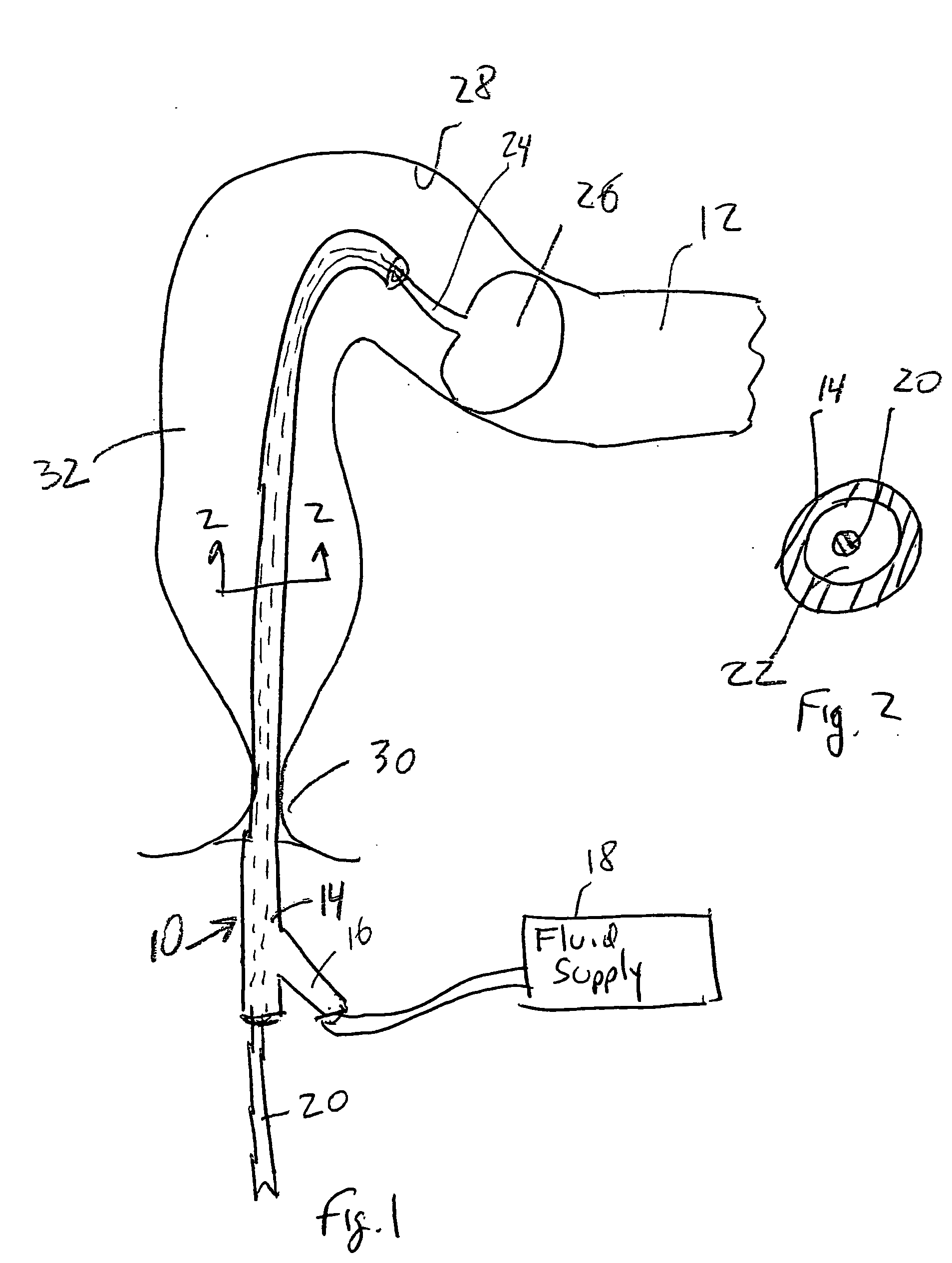 Guidewire for use in colonic irrigation