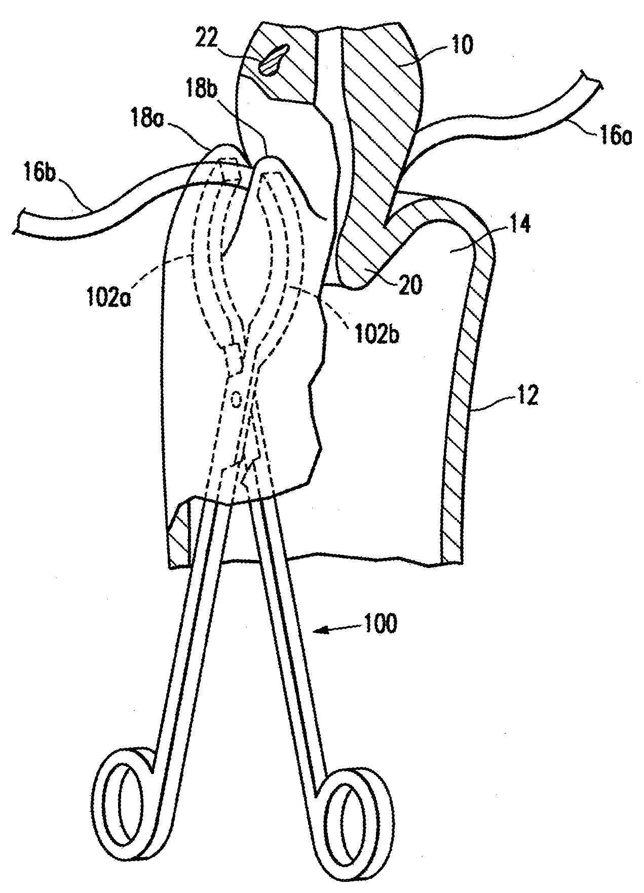 Methods for minimally invasive, non-permanent occlusion of a uterine artery