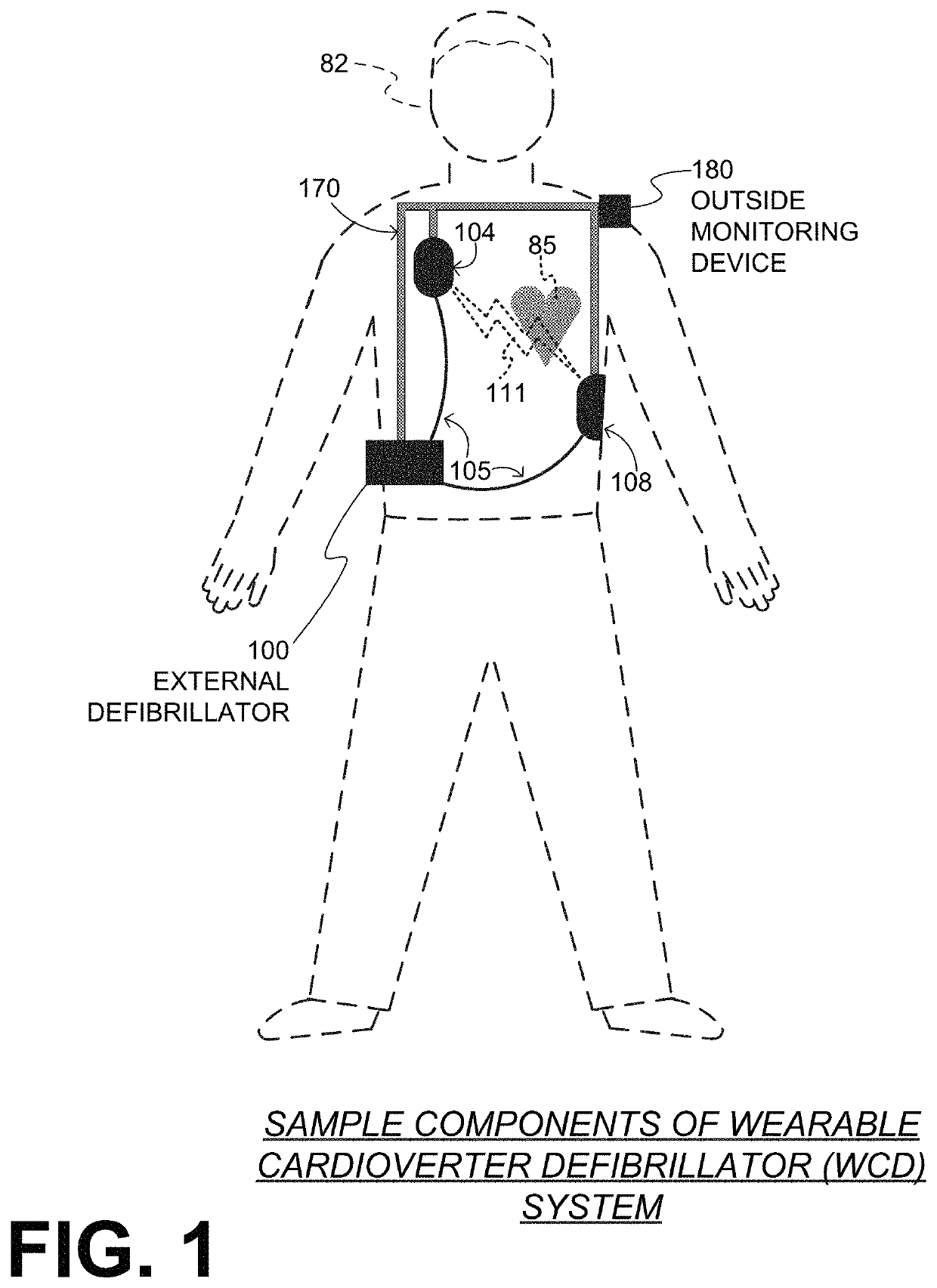 Wearable cardioverter defibrillator (WCD) system detecting QRS complexes in ECG signal by matched difference filter