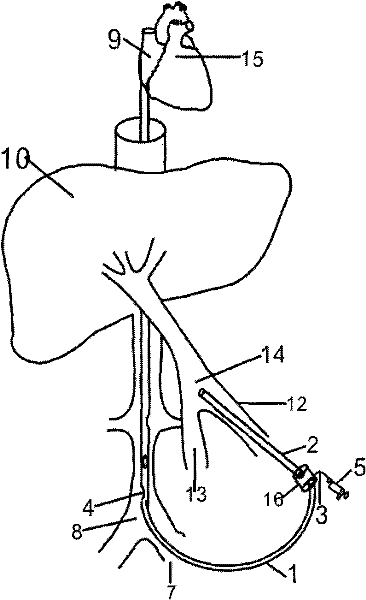 Vena cava shunt and portacaval transfer anticoagulation catheter and preparation method thereof