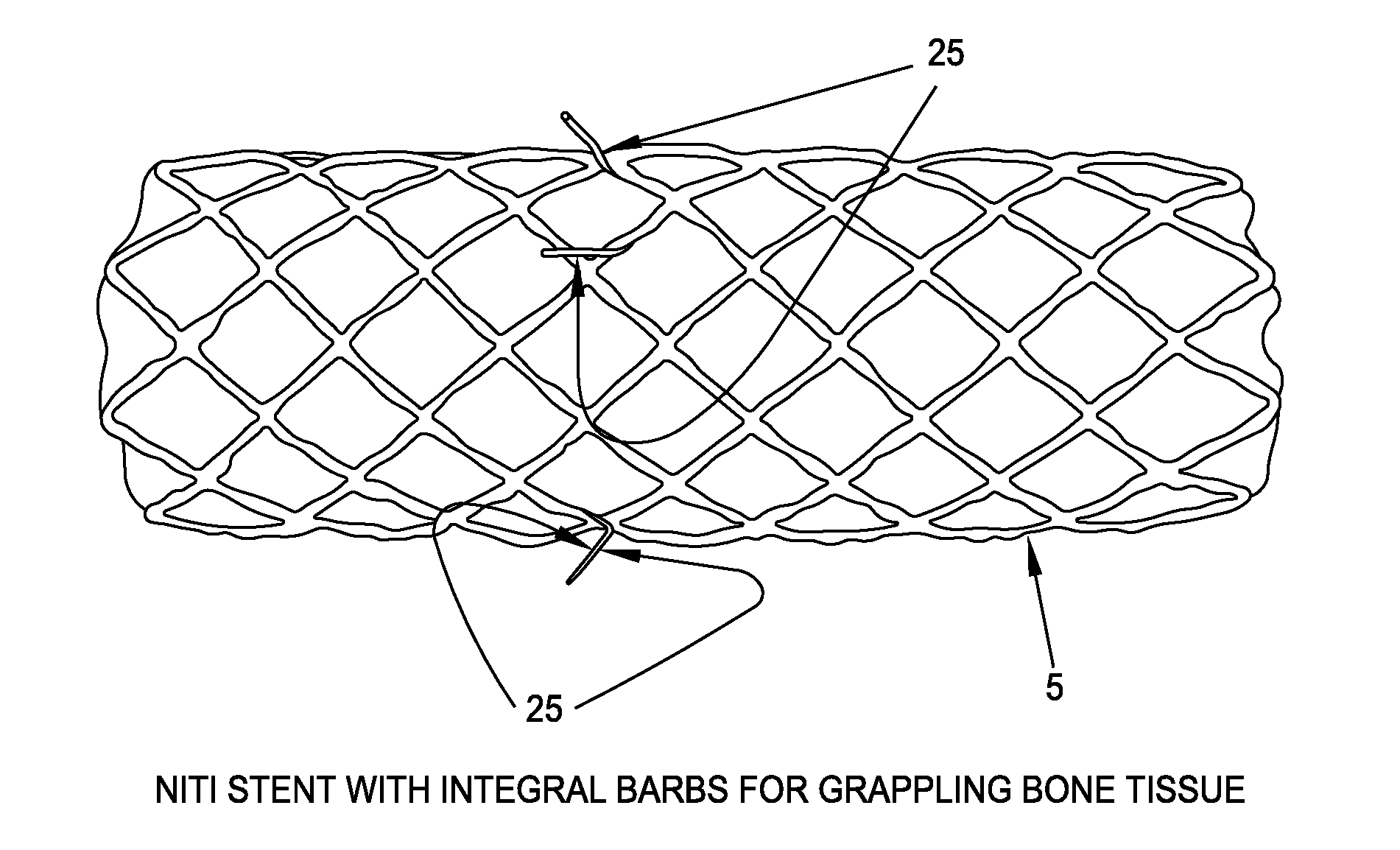 Osteosynthetic shape memory material intramedullary bone stent and method for treating a bone fracture using the same