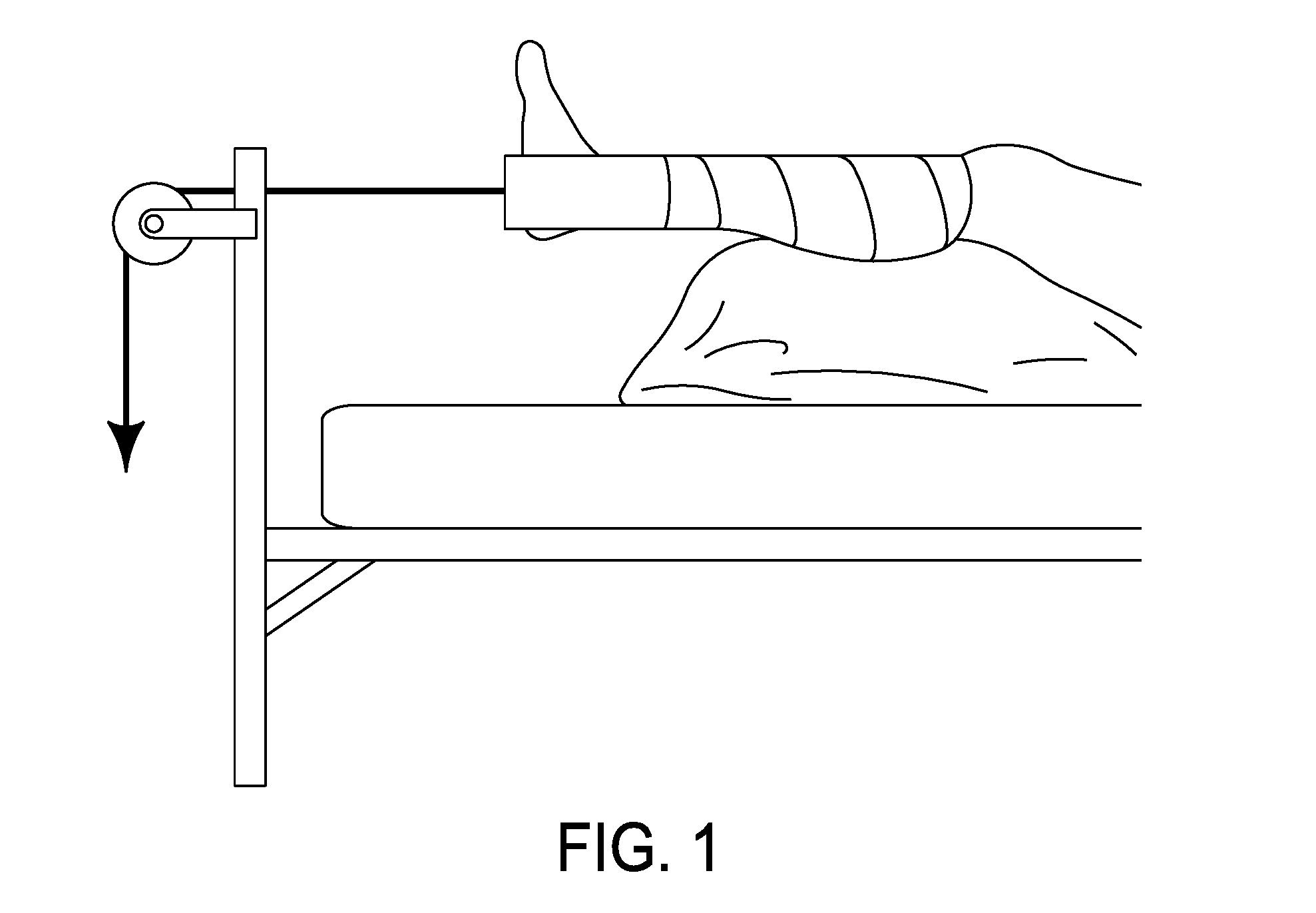 Osteosynthetic shape memory material intramedullary bone stent and method for treating a bone fracture using the same