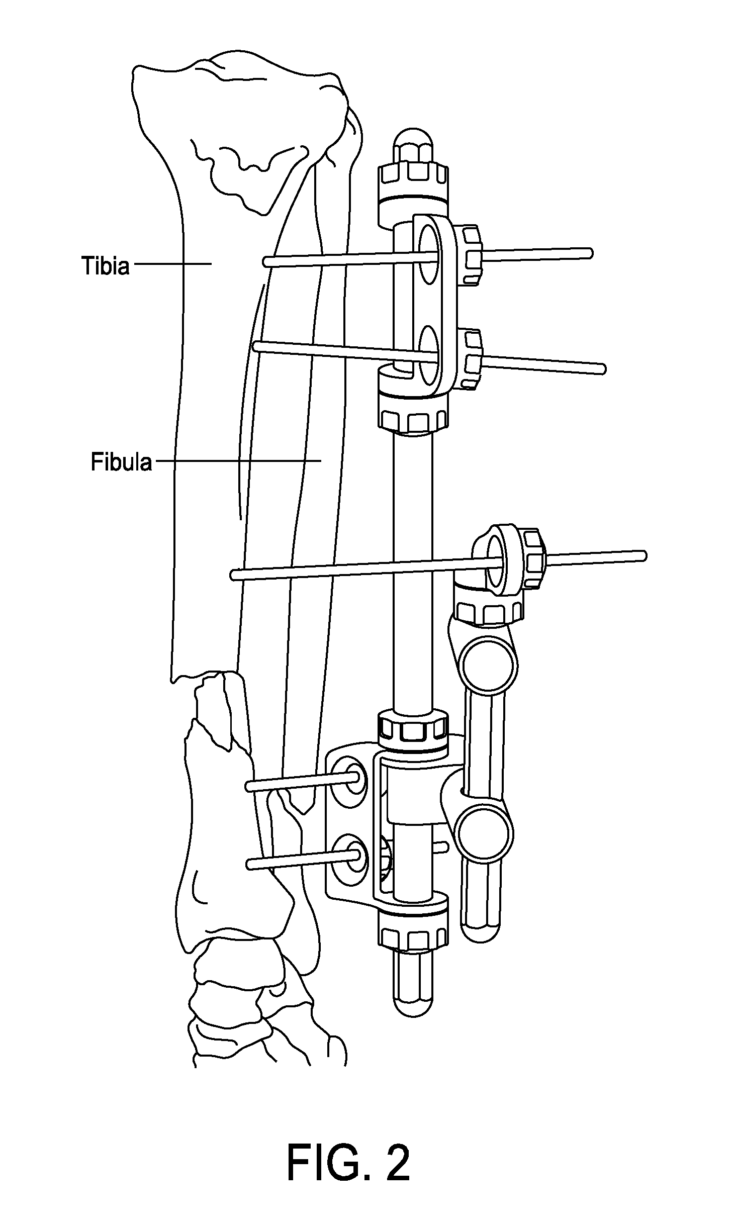 Osteosynthetic shape memory material intramedullary bone stent and method for treating a bone fracture using the same