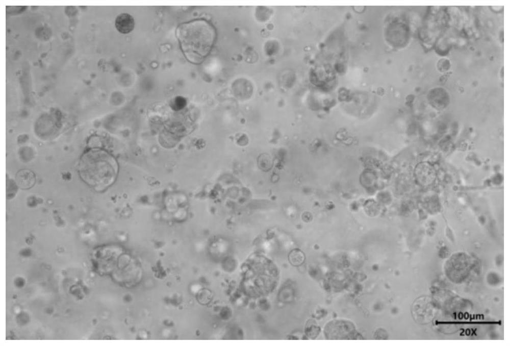 Special culture medium for lung cancer organoid and culture method