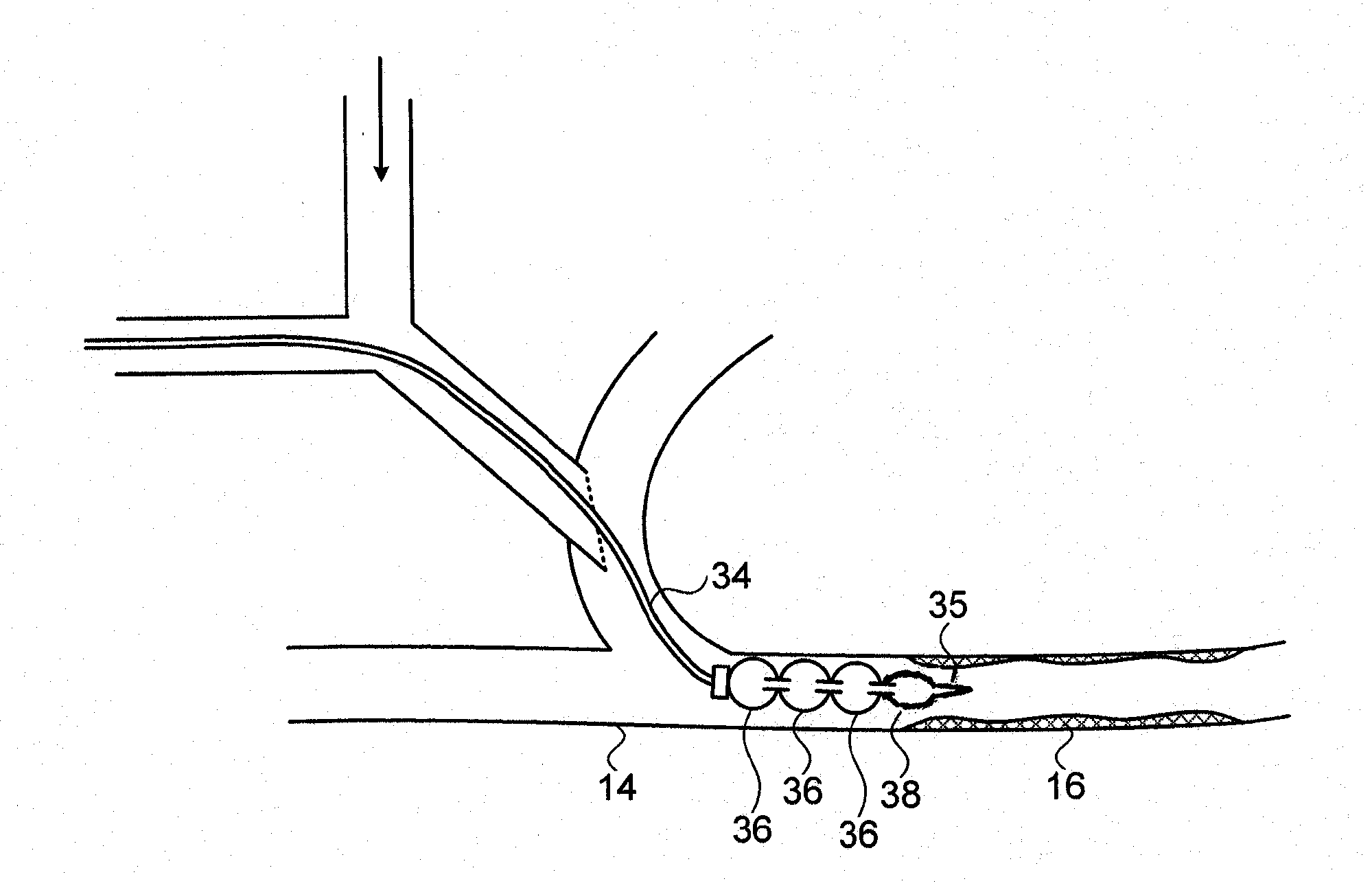 Device for prevention of shunt stenosis