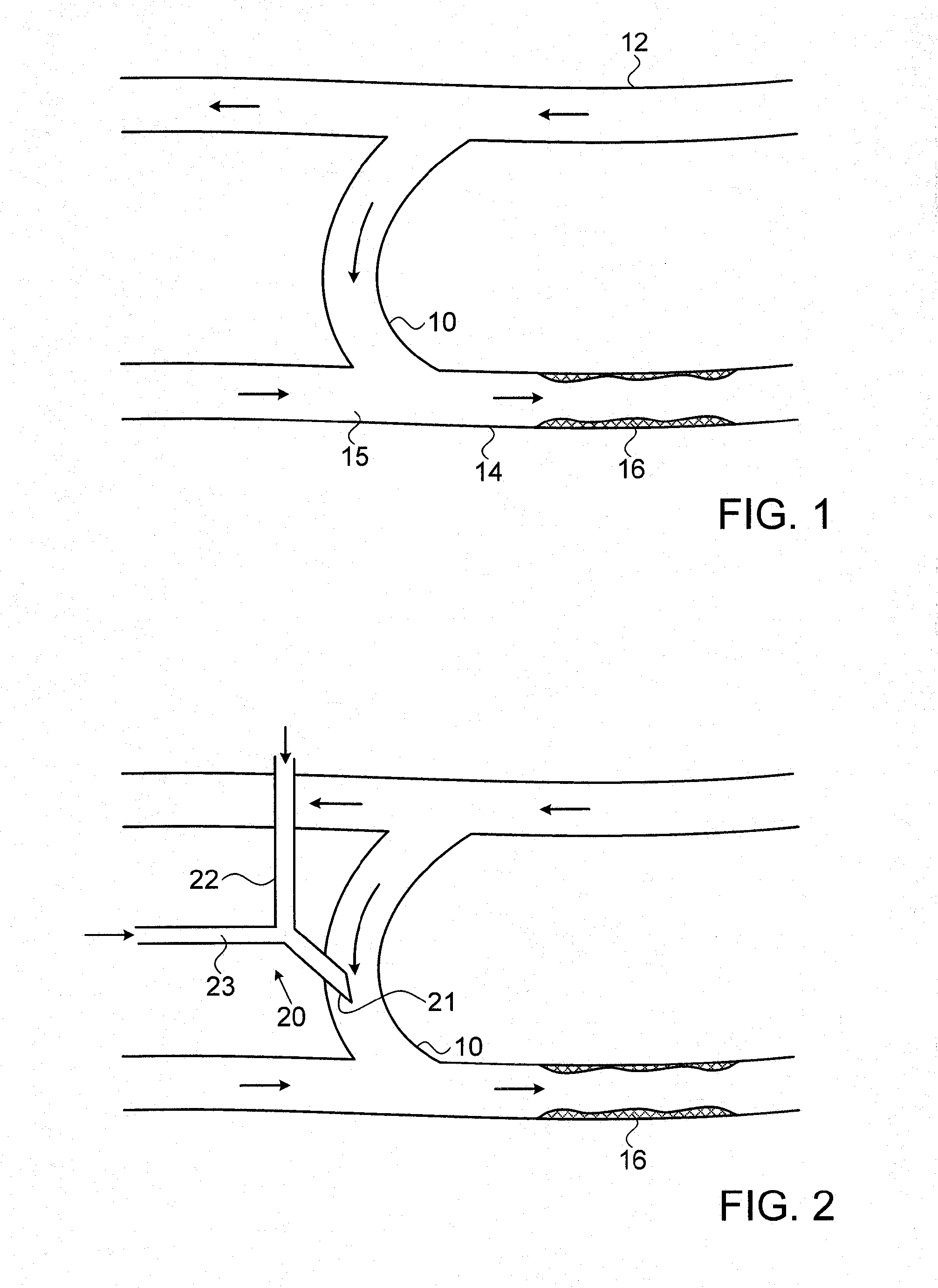 Device for prevention of shunt stenosis