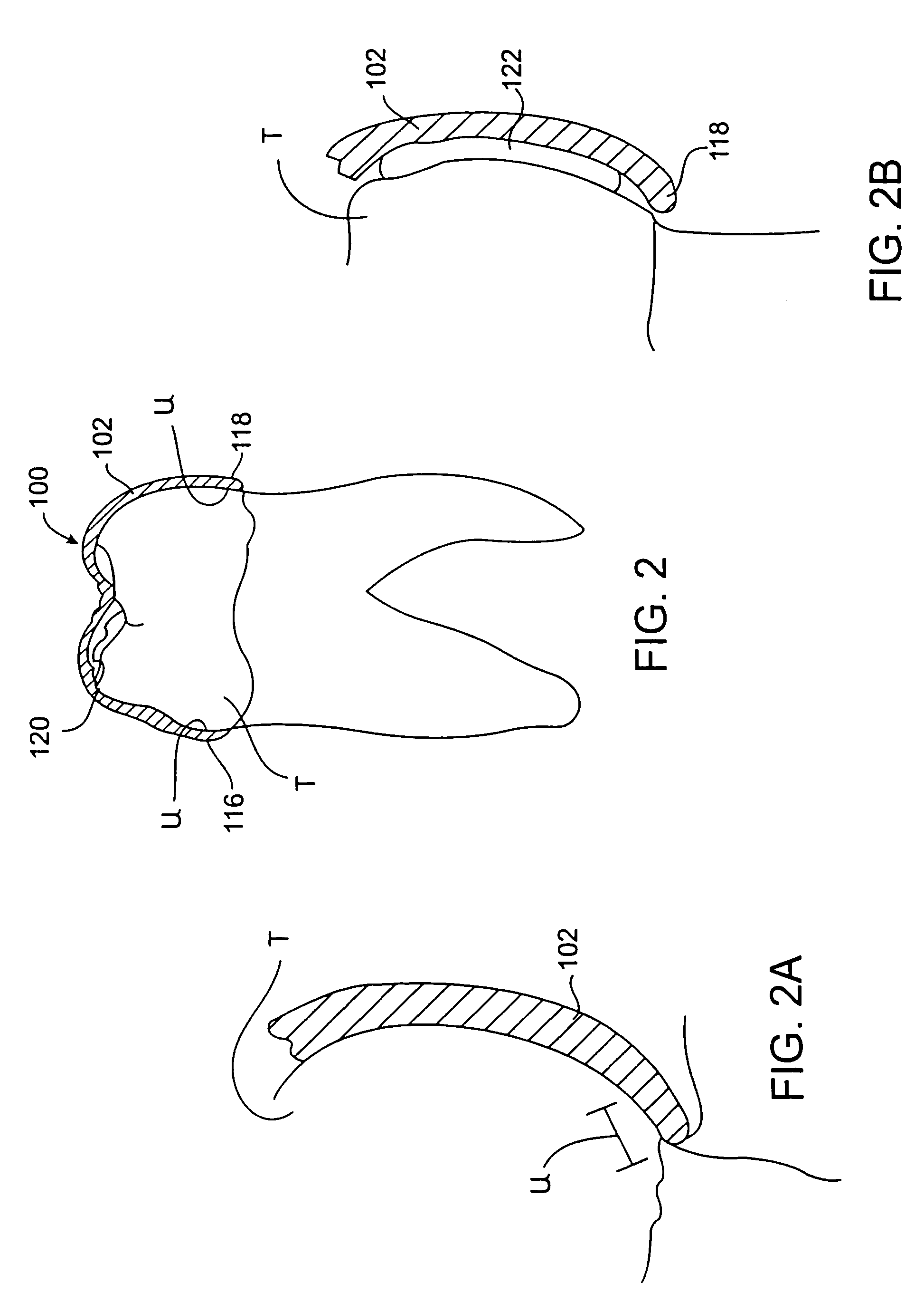 Tooth positioning appliances and systems