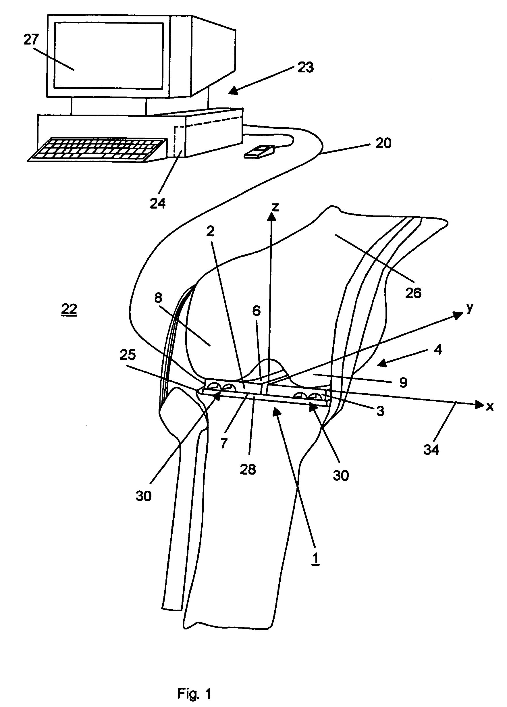 Device for measuring tibio-femoral force amplitudes and force locations in total knee arthroplasty