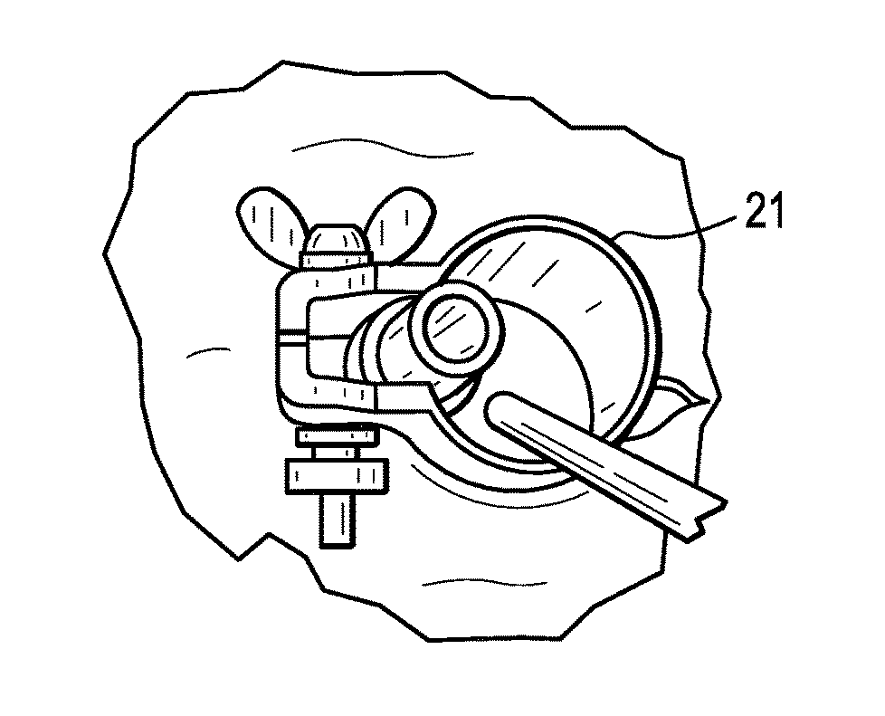 Method and instruments for interbody fusion and posterior fixation through a single incision