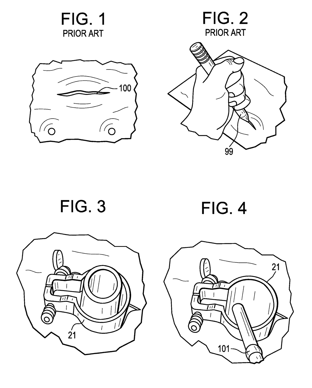 Method and instruments for interbody fusion and posterior fixation through a single incision