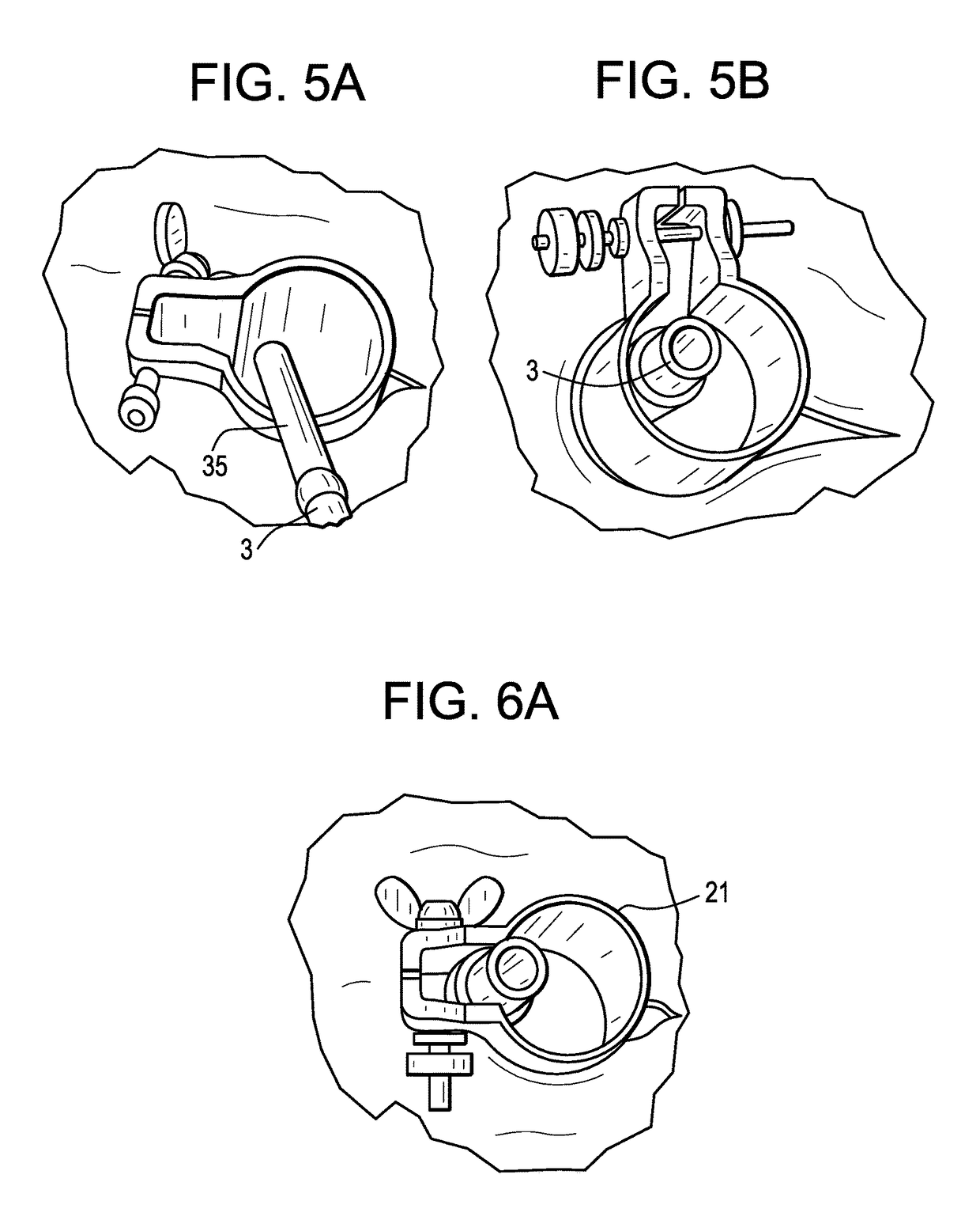 Method and instruments for interbody fusion and posterior fixation through a single incision