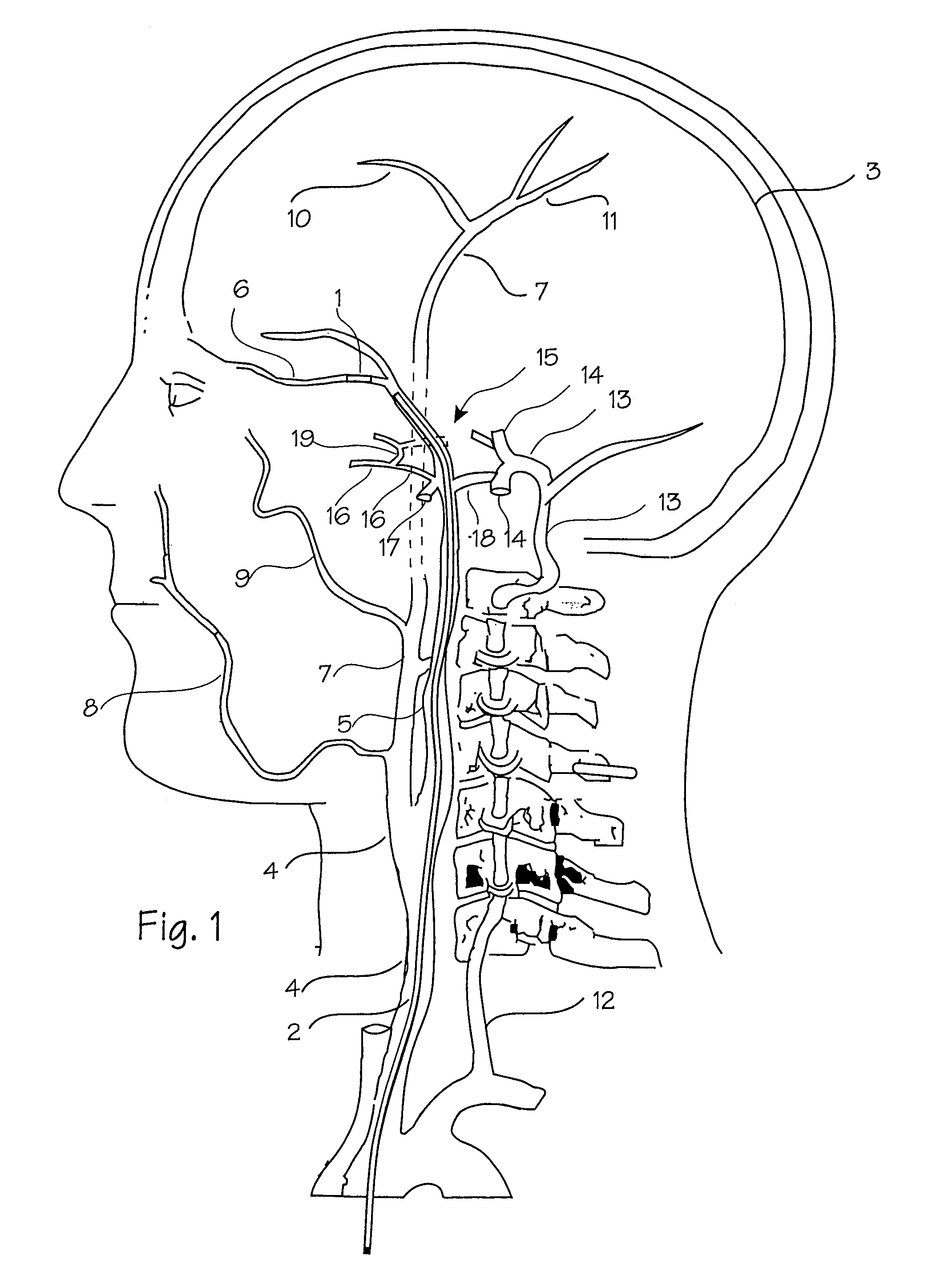 Intracranial stent and method of use