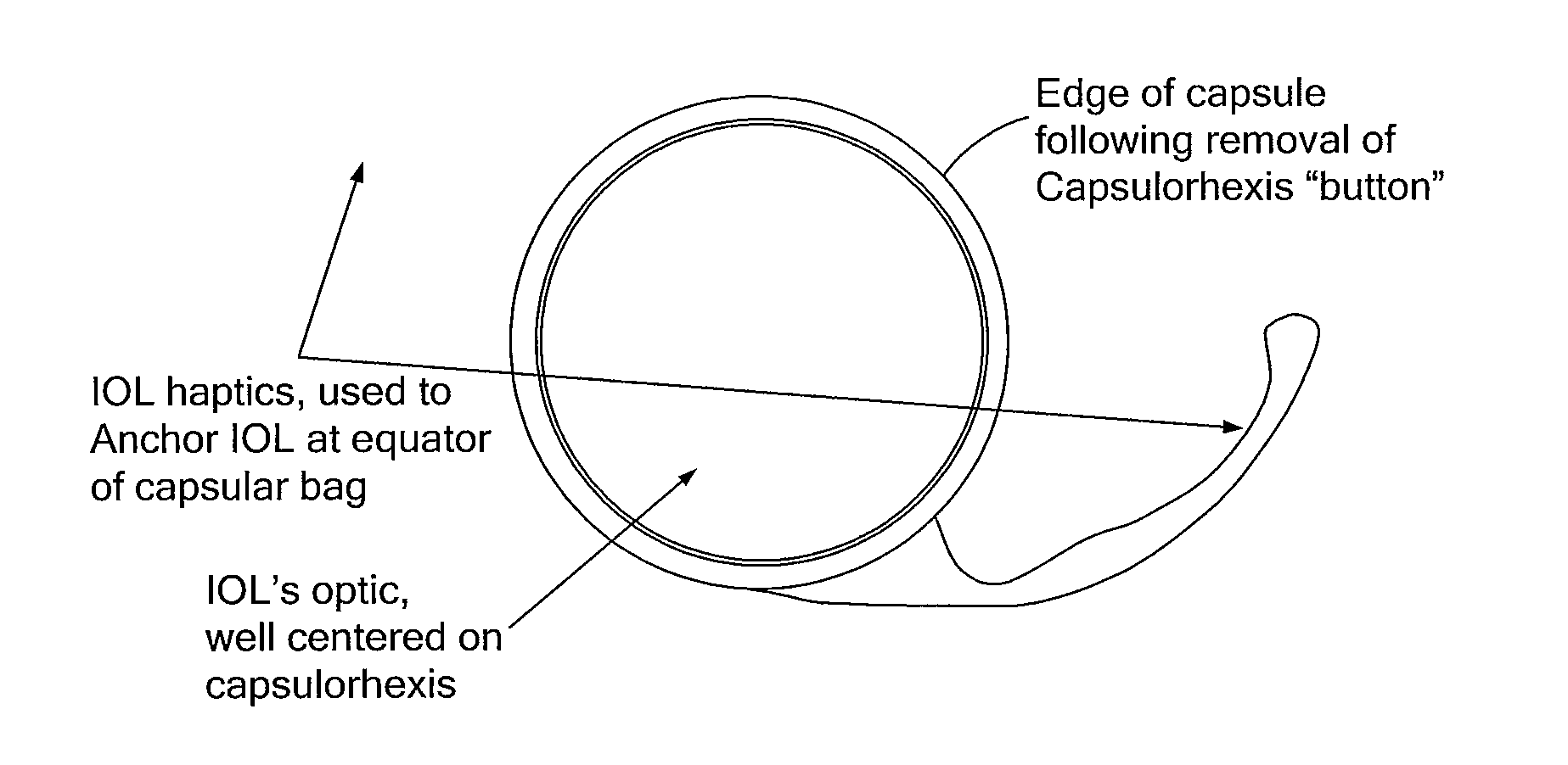 System and method for measuring tilt in the crystalline lens for laser phaco fragmentation
