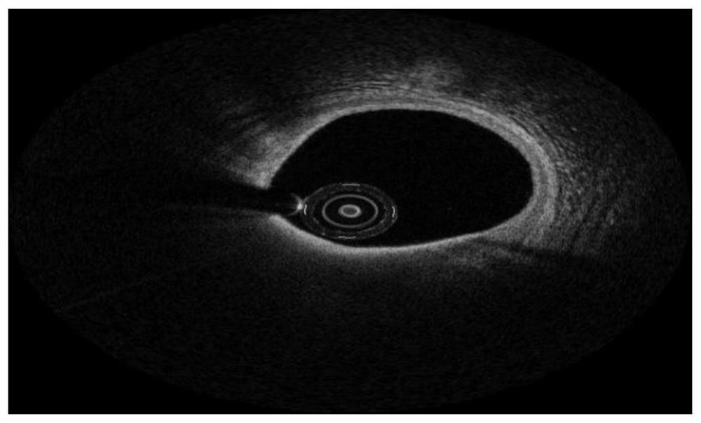 A method and device for automatic detection of thin fibrous cap plaques based on cardiovascular OCT images