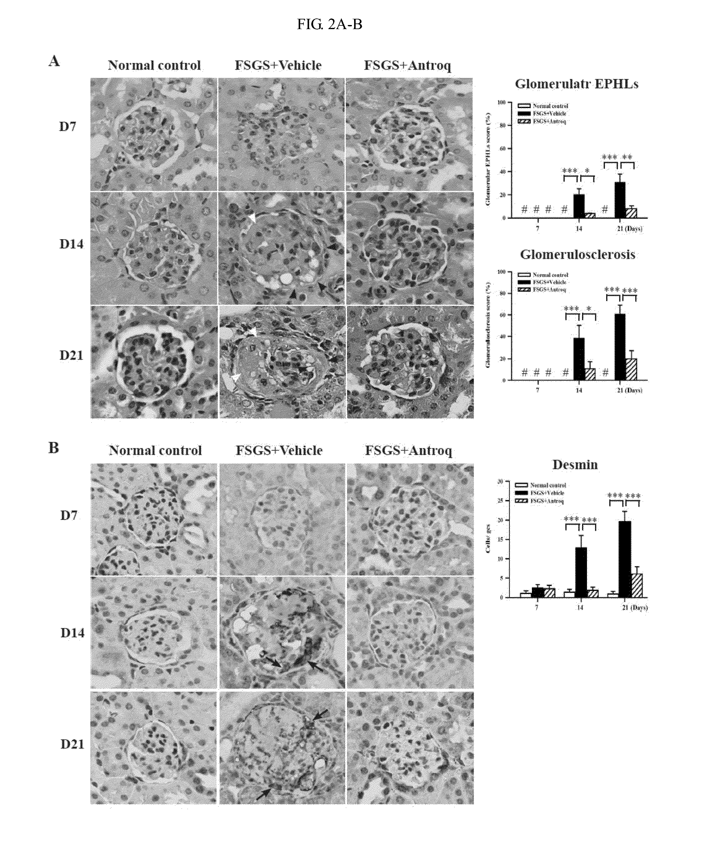 Methods and compositions for treating kidney disorders