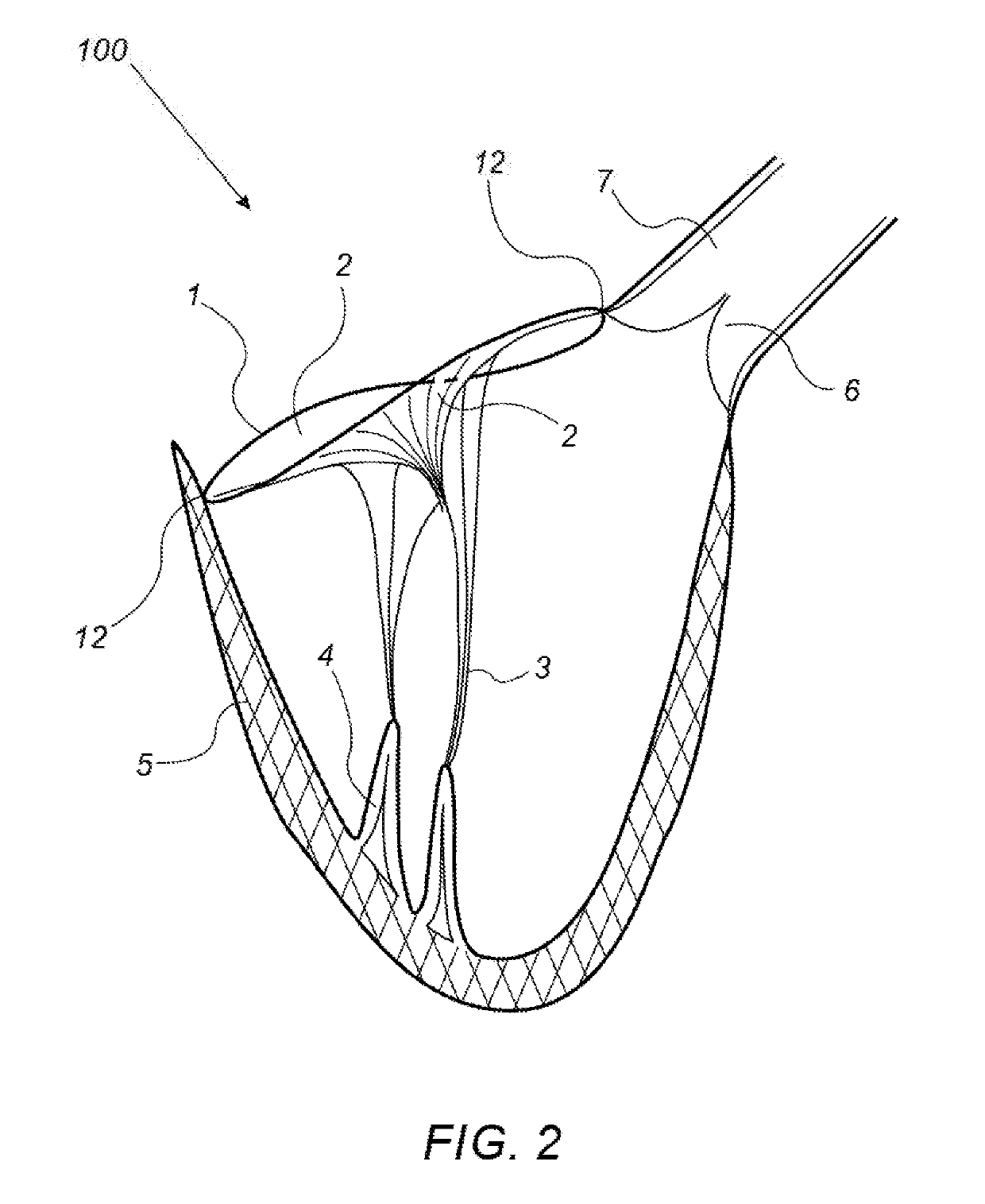 Naturally designed mitral prosthesis