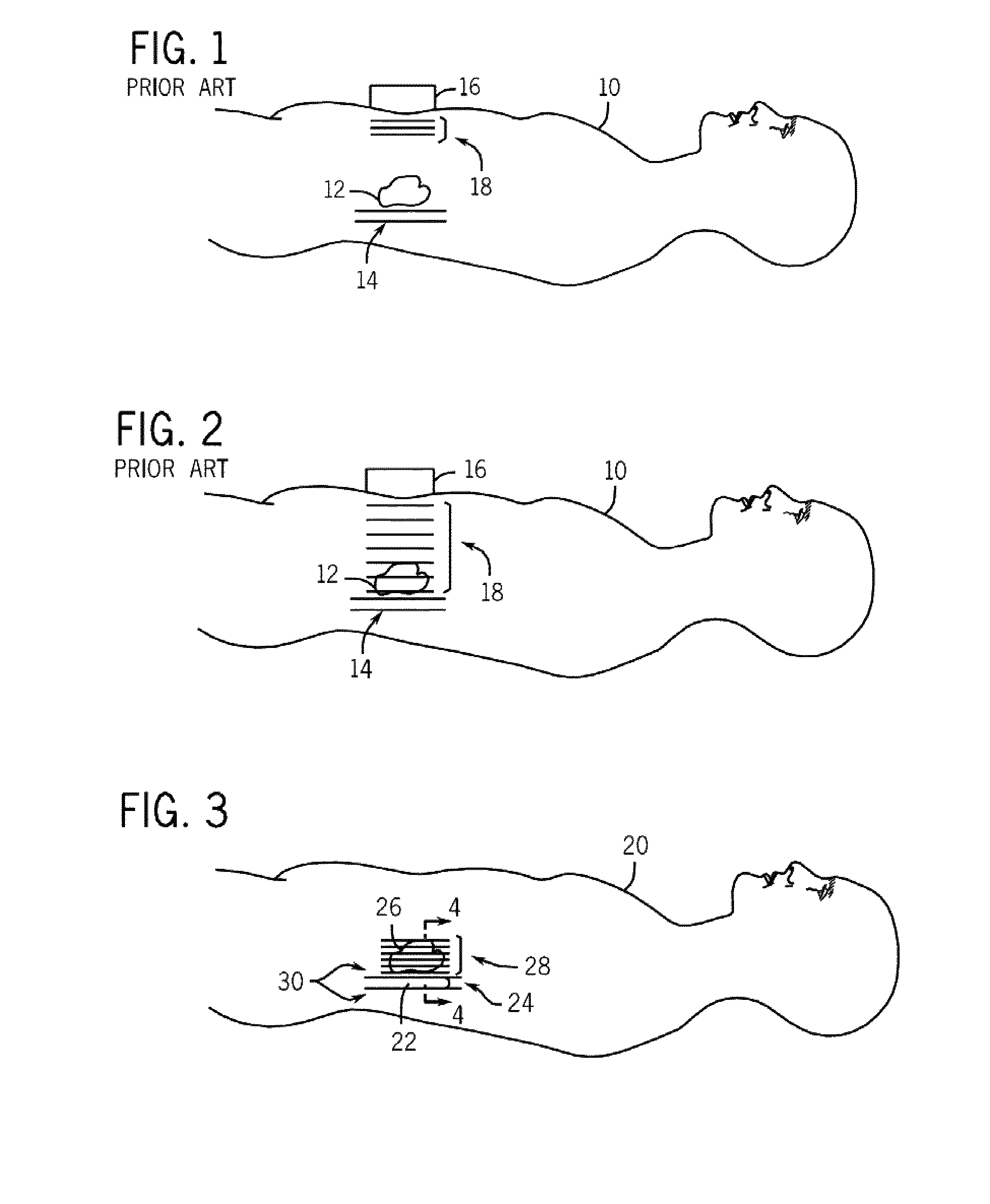 System and method for intracorporeal elastography