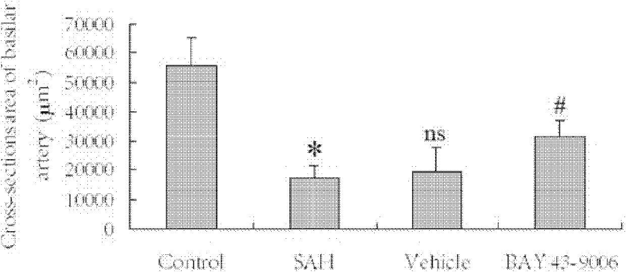 Application of sorafenib to treatment of cerebral vasospasm (CVS) after subarachnoid hemorrhage (SAH)