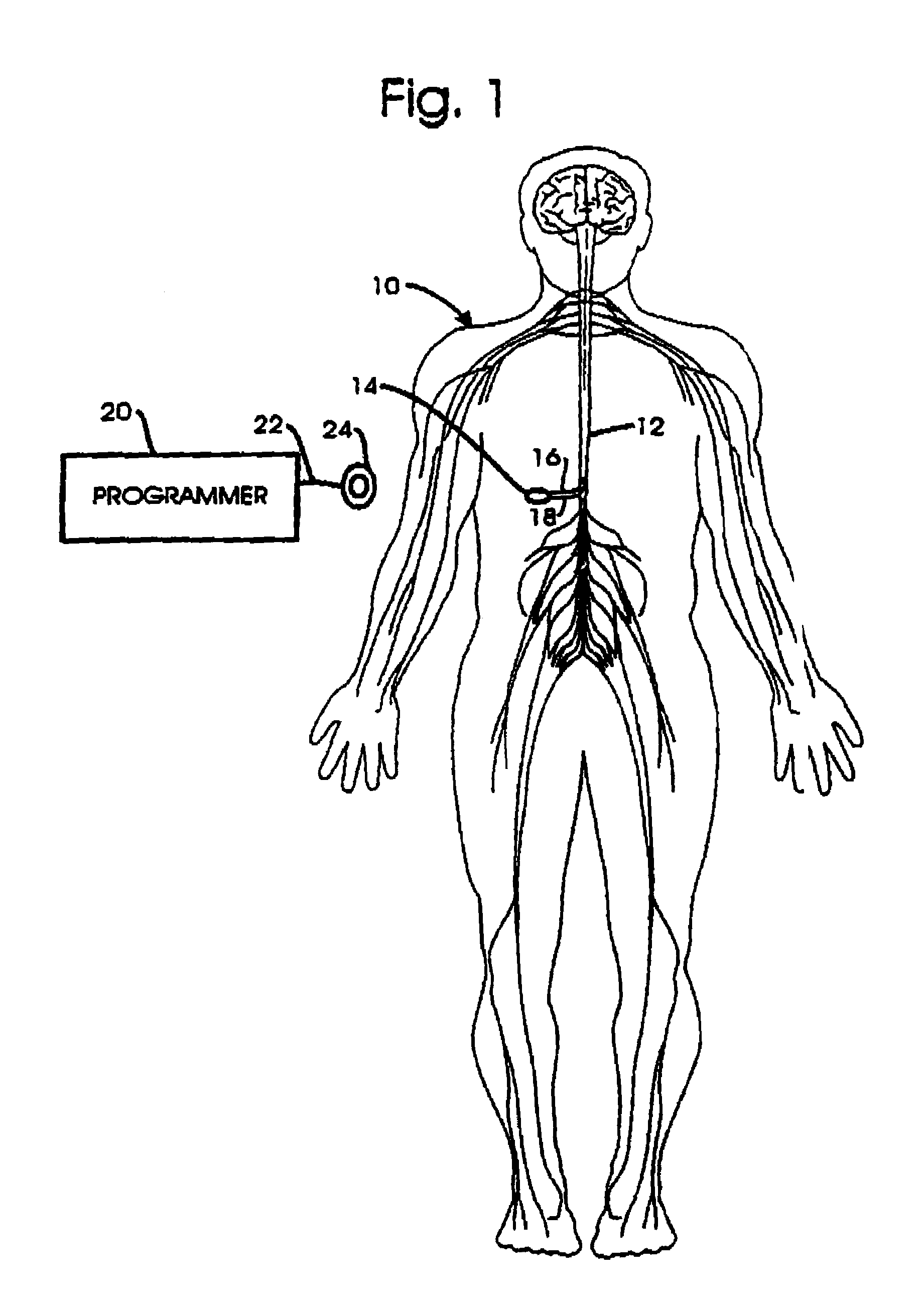 Technique for adjusting the locus of excitation of electrically excitable tissue