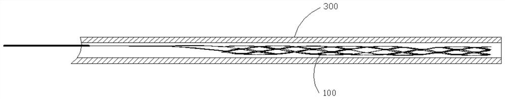 Thrombectomy