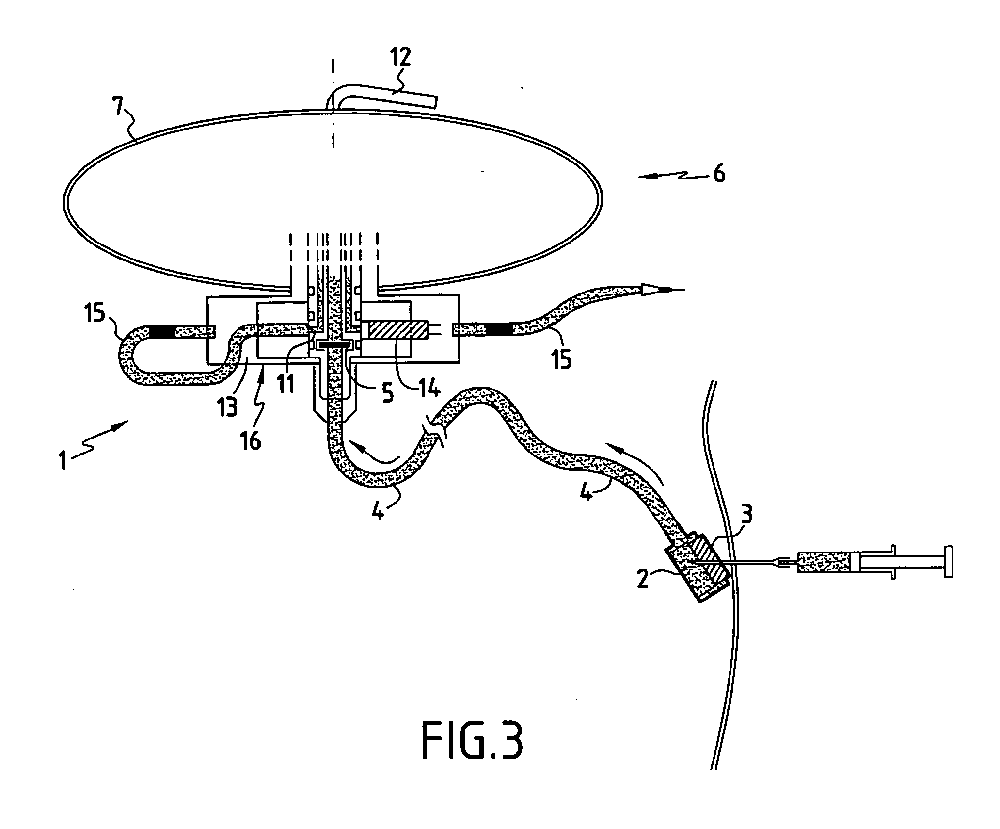 Implantable perfusion device