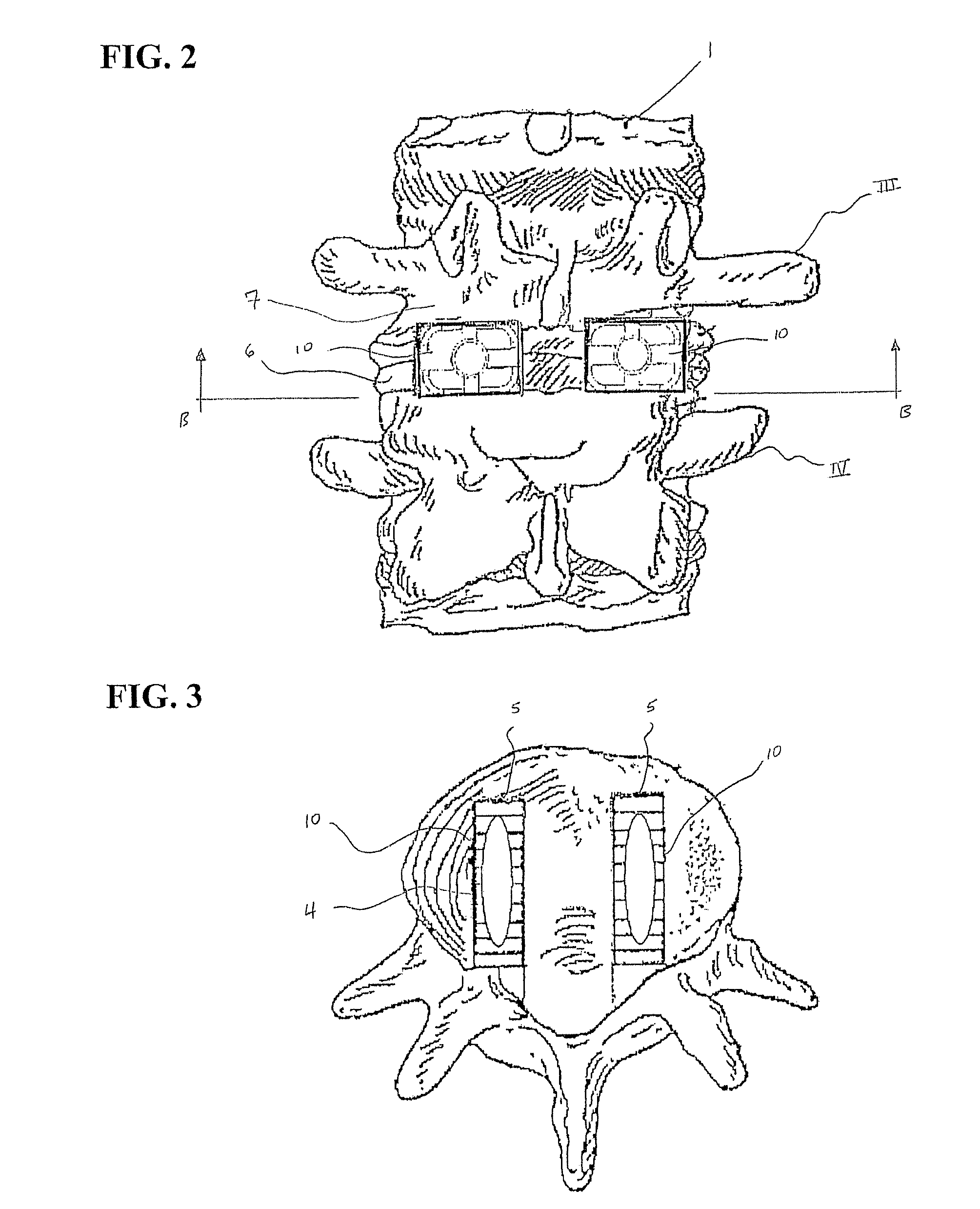 Spinal cage implant