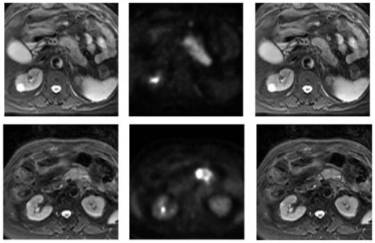 Pancreatic tumor image segmentation method based on dense connection network transfer learning
