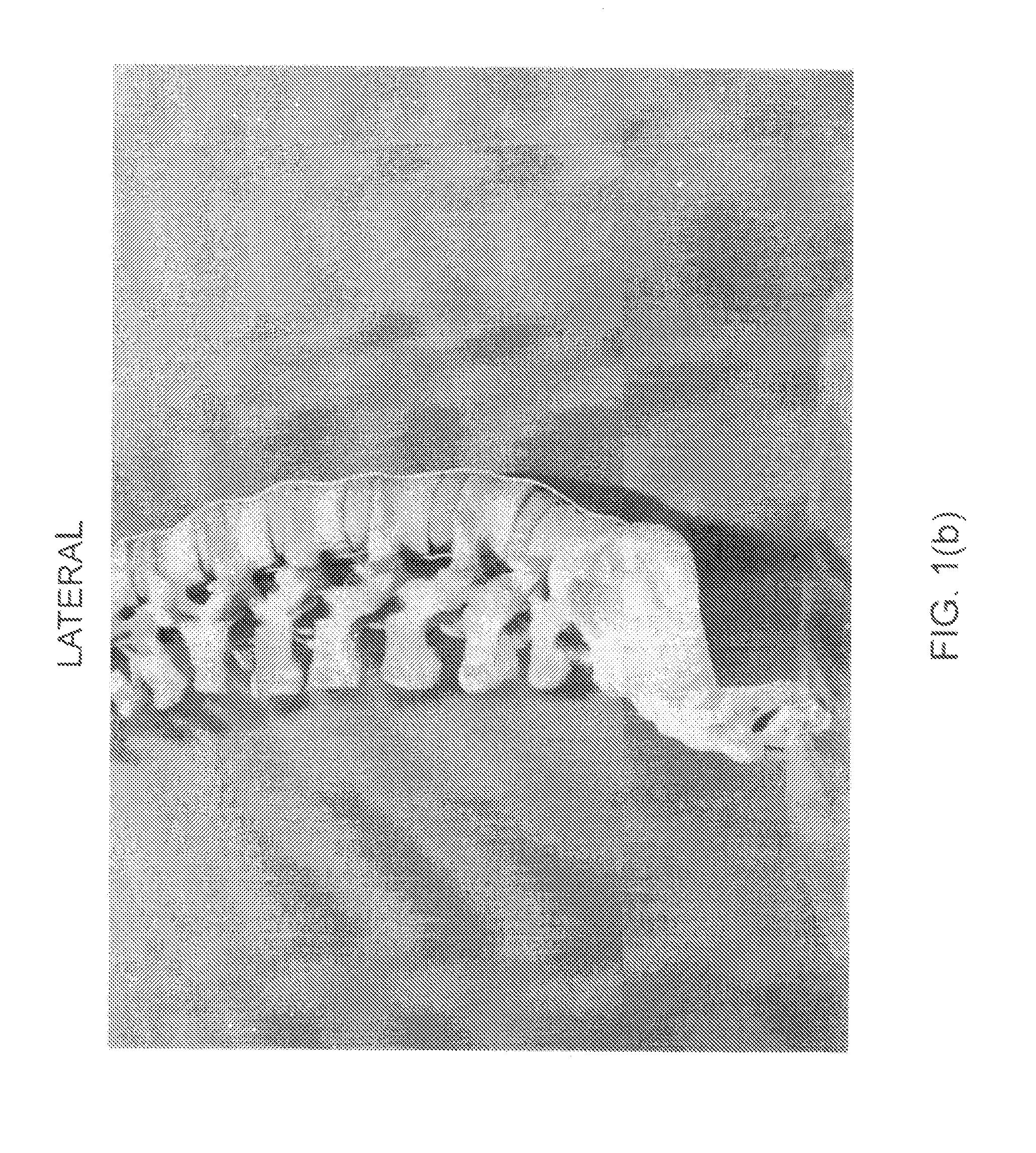 System for determining and placing spinal implants or prostheses