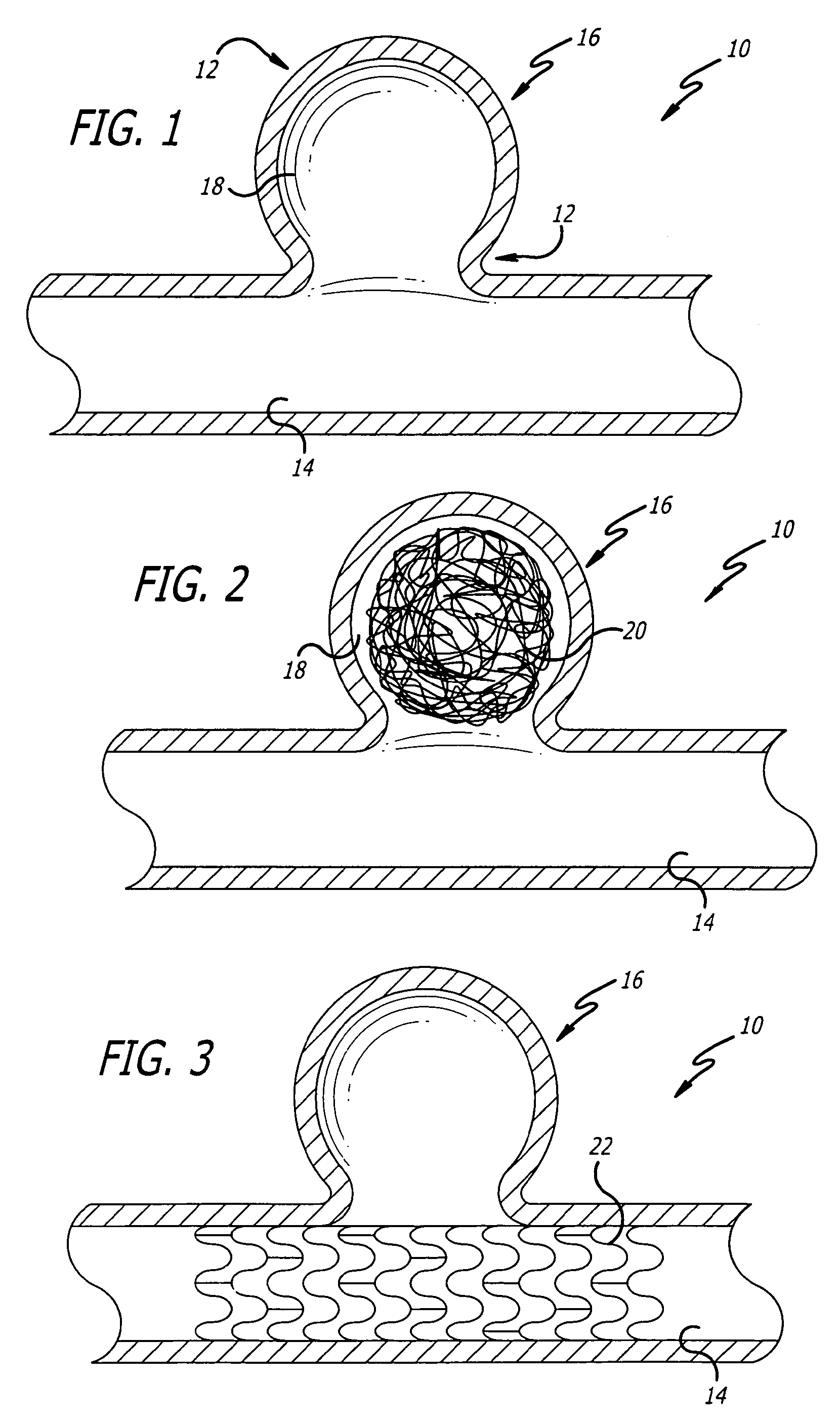 Aneurysm Treatment Device And Method Of Use